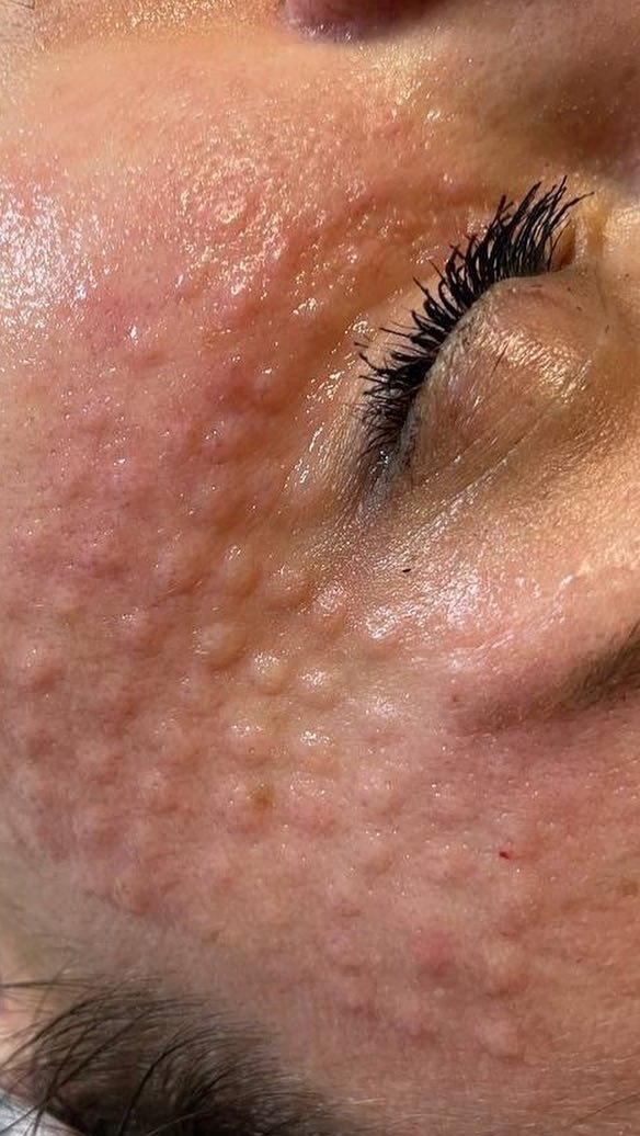 BOOSTE DEINE HAUT ✨
Biostimulatoren wie Profhilo, polynukleotidbasierte Präparate sowie Skinbooster und Mesotherapie gehören zu den modernsten Möglichkeiten, die Haut nachhaltig zu stärken. Sie unterstützen die natürliche Regeneration, verbessern die Feuchtigkeitsbindung und fördern die Bildung von Kollagen und Elastin.
Die Haut wirkt dadurch glatter, frischer und insgesamt revitalisiert, ganz ohne künstliches Volumen ✨
In unserer Praxis wählen wir die Methode aus, die am besten zu deiner Haut und deinen Zielen passt, und unterstützen sie dabei auf eine besonders sanfte und natürliche Weise.
✔️ direkt mehr Glow und sichtbare Frische
✔️ Natürliche Regeneration statt künstlicher Fülle!
✔️ Reduktion von Linien und Fältchen
✔️ Breites Anwendungsspektrum: Geeignet für Gesicht, Hals, Dekolleté, Augenpartie (gegen Augenringe) und Hände
✔️ Langanhaltende Ergebnisse: 6-12 Monate
✔️ Keine Ausfallzeiten oder Schmerzen!
✔️ hocheffektive Biostimulatoren zur Behandlung von Augenringen, Tränensäcken und Krähenfüßen
#beauty #bamberg #polynukleotide #unterspritzung