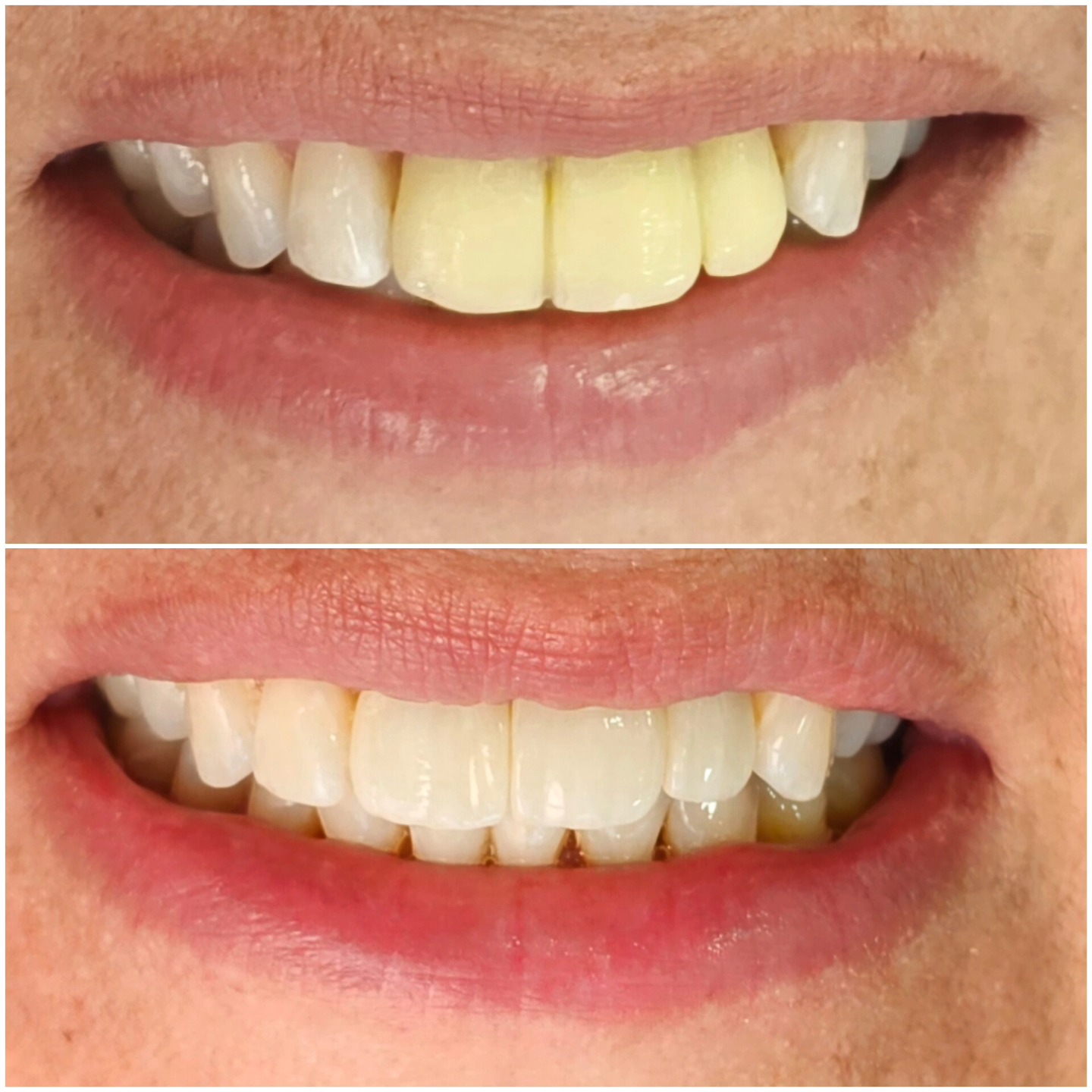 Un caso muy muy interesante y muy muy retador en donde partimos de una pérdida total del hueso (0 hueso)... reconstruimos hueso, reconstruimos encía, colocamos implantes de manera guiada por computador y realizamos coronas de manera Digital... No son dientes... son una nueva vida...
#implantes #implantesdentários #cad #digitalart #smile #newlife #dentaltourism #dentalimplants #colombia