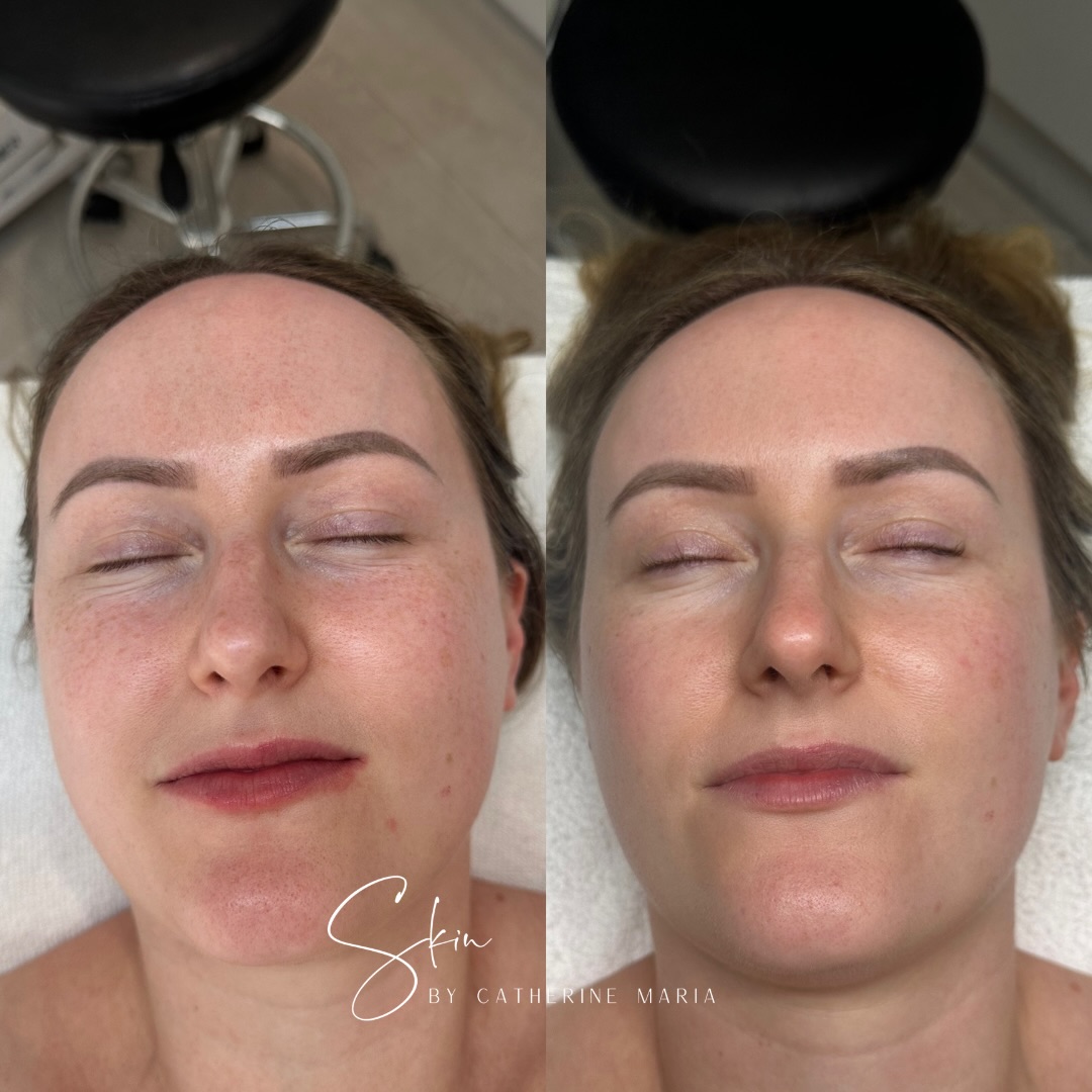 Introducing Mrs Murphy 🤍
Drew has been a long-term client and she reached out to me last year to help prep her skin for her wedding in November 2025. She committed to regular facials and truly trusted the process, and the results speak for themselves.
We worked together over several months having a combination of DECAAR Algae Peel, Dermalux LED light therapy and DermaFrac Infusion.
Each treatment was chosen at the right time for her skin, focusing on improving her redness, strengthening her skin barrier, improving texture, boosting hydration and supporting a healthy glow.
By the time her big day arrived, her skin looked calm, clear, radiant and beautiful.
I’m super proud of her commitment, and so grateful she trusted me with her skin journey.
Look at her beautiful wedding photos in the Cotswold 🥺
@drewrubymurphy
@thebuckslife
If you’re planning a wedding (or event), or you simply want to invest in your skin long-term, this is your sign to start early.
📩 DM to start your skin journey
📍 Aylesbury, Buckinghamshire
📞 07759567391
📩 info@skinbycatherinemaria.com
🌍 www.skinbycatherinemaria.com
#aylesbury #aylesburybusiness #aylesburybeauty #buckinghamshirebusiness #buckinghamshirelife