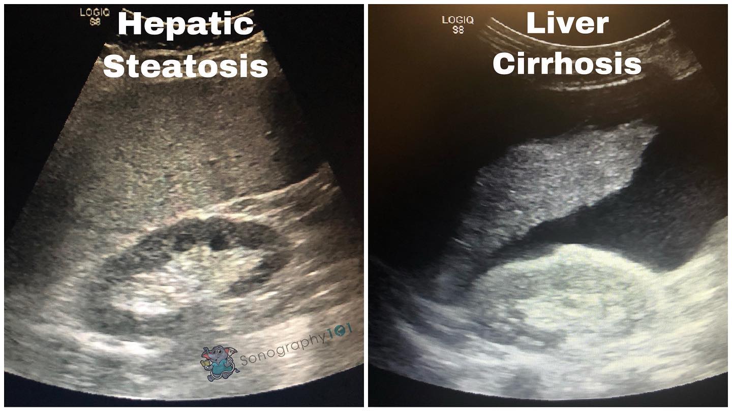 Hepatic Steatosis also known as Fatty Liver Disease is when the liver parenchyma is hyperechoic. If continuous damage is sustained to the liver long-term, cirrhosis can then develop. Subsequently, ascites will start to develop.