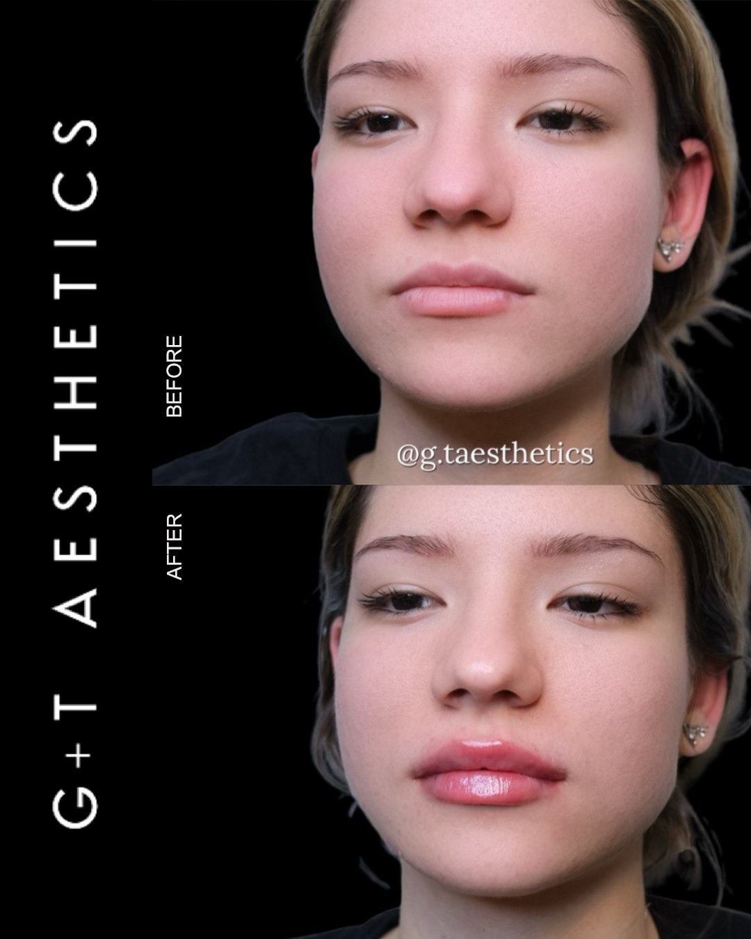 Defined, lifted and beautifully balanced 💋
Russian Doll Lips focus on shape and structure rather than overfilling, creating a refined and elegant finish.
Tailored results that complement your natural features.
📲Enquire or visit www.gtaesthetics.co.uk for more info.
#RussianDollLips #LipEnhancement #DermalFillersUK #NaturalResults #BeforeAndAfter