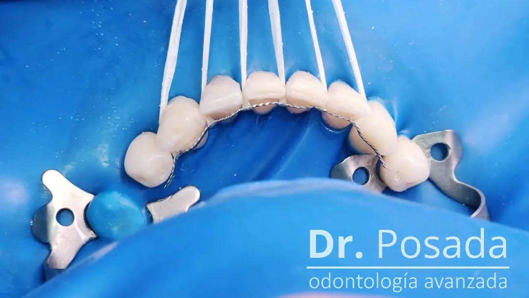 El Retenedor fijo, que al cementarse bajo aislamiento absoluto del campo operatorio (esa tela azul que aisla la humedad saliva y bacterias para mejorar inmansamente la adhesión), es un delgado pero resistente alambre que se adhiere a la parte posterior de los dientes para evitar que se muevan luego de haber sido alineados..
.
.
📲 304 652 90 22
☎️ 601 755 20 46i I
.
.
.
.
.
.
.
.
.
.
#ortodoncia #retenedoresfijos #fotografia #fotografiaintraoral #sorisaperfecta #ortodonciacolombia #bogota #esteticadental