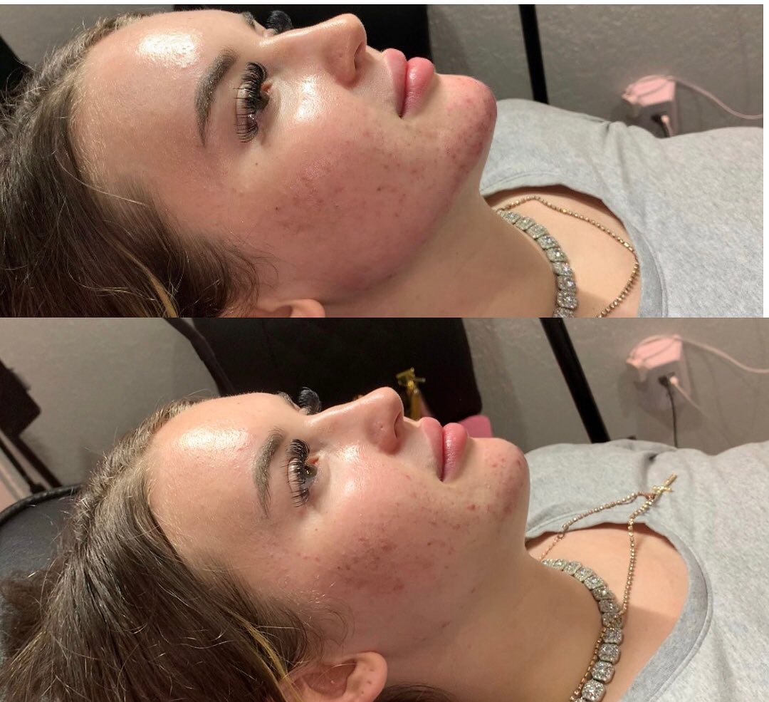 Facial balancing is so important for getting that side profile snatched 😍 1.5mL injected in lips. 1mL injected in jawline 1mL injected in chin together = perfection 😍. #explorepage #facialbalancing #fillerstampa #lipfillerstampa #lipfillerbradenton #lipfillerstpete #jawline #chinfiller #nosefiller #cheekfiller #hyalruonpentraining #hyaluronpen #noneedlefiller #lashestampa #lashesbradenton #makeuptutorial