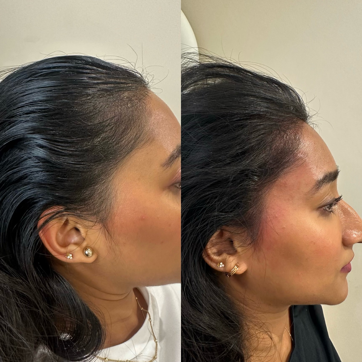 Dr CYJ hair filler is a cutting-edge, non-surgical hair restoration treatment that utilizes a combination of hyaluronic acid, biomimetic peptides, amino acids, and vitamins to stimulate hair growth and improve hair density.
Benefits:
Prevents hair loss
It speeds up hair regrowth
Thickens the hair
Stimulates circulation and improves blood supply to the scalp
Revitalizes hair follicles
Nourishes the scalp
Before: Left image
After: Right image
@dr_cyj
#hairgrowth #drcyj #hairloss #hairlosssolution #hairlosstreatment #clinic #4u