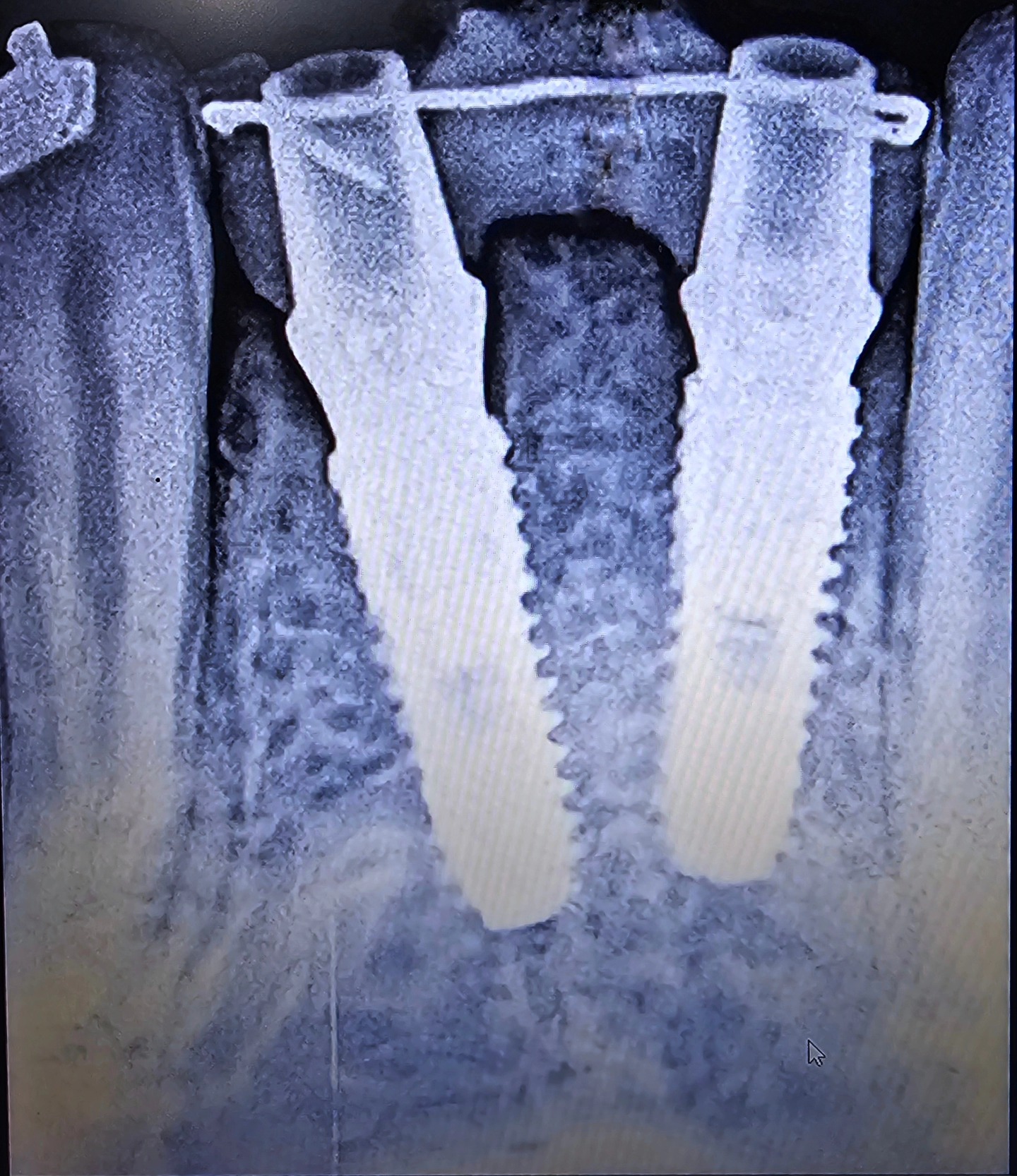 Immediate implant placement after removal of lower front incisors followed by immediate loading of provisional screw retained prosthesis .
What drill is used to modify/shape the bone crestal to the implant to aid in proper abutment seating?