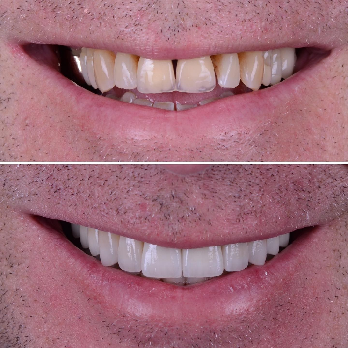 Functional full mouth rehabilitation after successful treatment of periodontal disease.
The primary goal here was not an esthetic treatment. But of course, whenever we treat teeth we make sure they look nice and function well 😃👍
#abudhabidentist #dentistabudhabi #dubaidentist #dentistdubai #smiledesign #digitalsmiledesign #zahnarzt #dentist #estheticdentistry #veneers #3shape #highenddentistry #digitaldentistry #sboe #biologicaldentistry #predictibledentistry #adent #cosmeticdentistry #cosmeticsurgeryabudhabi #veneersabudhabi #veneersdubai #fullmouthrehabilitation #biomimeticdentistry #functionaldentistry