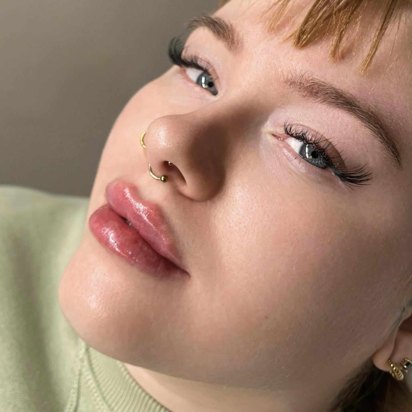 Russian Lips 💉 #hyaluronsäurelippen #lippenunterspritzung #bamberg #lippen #hyaluron