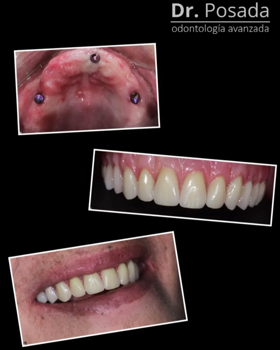 🥺Si eres un paciente que ha perdido todos tus dientes, hoy te queremos presentar una de las muchas soluciones posibles; 🤯🤯🤯La #sobredentadura , que es una prótesis que se une a unos broches en tu hueso, en este caso sobre 3 implantes estratégicamente ubicados por medio de la #cirugíacomputarizada🪡 , brindando comodidad, función y una caracterización muy natural.😁
🤩Ventajas de este tratamiento
💠No se mueve
💠Tendrás una mayor seguridad al hablar y comer.
.
.
.
.
.
.
.
.
.
.
.
.
.
.
.
.
.
.
.
.
.
.
.
.
.
#sobredentadura #protesis #protesiscaracterizada #implantes #protesisremovible #smile😊 #digital #fotografiaintraoral #pacientemodelo #impresiondigital #odontologiabogota