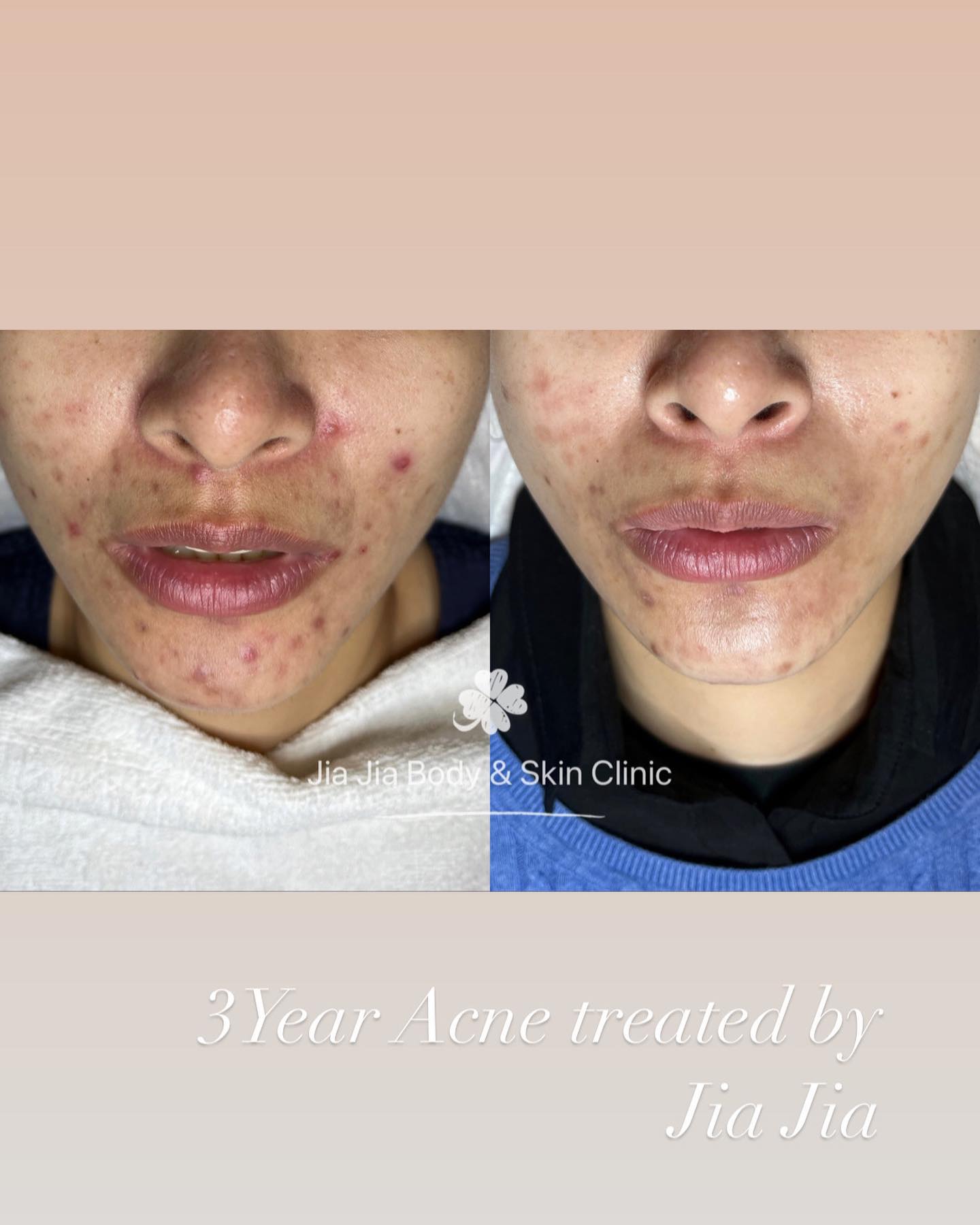 Result : 3 year Acne treat by Jia Jia
#acne #acnetreatment #clearskin