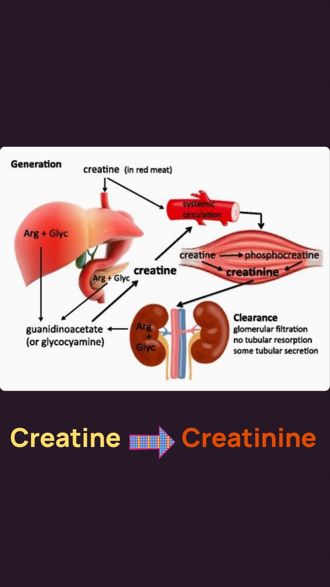 Your creatinine level depends on your muscle mass. Here is why that matters.
The mechanism:
Creatinine comes from creatine - the fuel your muscles use for explosive energy. About 1-2% of your muscle creatine breaks down daily. That waste product is creatinine.
More muscle = more creatinine production.
A bodybuilder will always have higher creatinine than someone with low muscle mass. That does not mean kidney disease. It means a bigger engine producing more exhaust.
A 2008 study confirmed: lean muscle mass significantly correlates with serum creatinine, independent of kidney function.
The Gym Mistake:
This is the number one mistake I see.
Intense exercise breaks down muscle tissue. If you lift heavy or run hard 24 hours before your blood test, you dump a massive creatinine load into your blood.
Your kidneys cannot clear it that fast.
Result: Your number looks artificially high. You get flagged. You worry. Maybe unnecessarily.
The Fix:
No heavy exercise 48 hours before a kidney panel.
What you can do:
- Walk
- Stretch
- Yoga
Save the heavy lifting for after the lab visit.
Save this for your next blood test.
References:
Baxmann AC, et al. Clin J Am Soc Nephrol. 2008
Pinto-Sietsma SJ, et al. EClinicalMedicine. 2020
--
Sean Hashmi, MD, MS, FASN
Board-Certified Nephrologist
Medical Disclaimer: Educational content only. Not medical advice.
#Creatinine #KidneyHealth #KidneyFunction #MuscleMass #GymTips #BloodTest #LabResults #Nephrology #Bodybuilding #Exercise #FitnessHealth #KidneyAwareness #eGFR #WorkoutTips #HealthEducation #DrHashmi #MedicalMyths #KidneyDisease #HealthyLiving #GymLife #StrengthTraining #FitnessFacts #HealthTips #KidneyCare