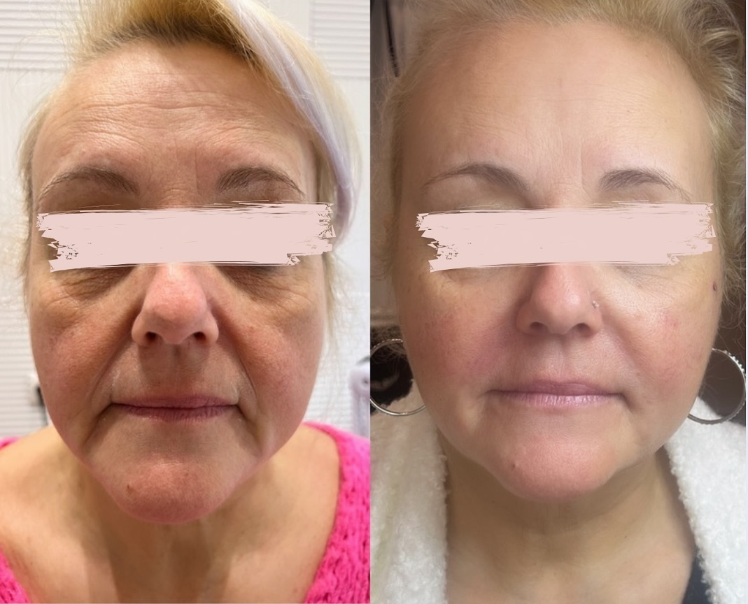 ✨ Redonnez éclat et jeunesse à votre visage ! ✨
Avec le temps, la peau perd de son élasticité, et certaines zones du visage peuvent paraître plus marquées, comme la vallée des larmes, le sillon nasogénien ou encore les rides d’amertume.
Grâce aux injections ciblées d’acide hyaluronique, nous pouvons :
✔️ Estomper les creux pour un visage plus harmonieux.
✔️ Atténuer les rides profondes qui marquent la fatigue ou la tristesse.
✔️ Raviver les volumes naturels et sublimer vos traits tout en douceur.
👩⚕️Chez ma magnifique patiente, nous avons travailler le « Middle Face » en l’occurrence la vallée des larmes, les sillons nasogéniens et les rides d’amertumes â l’acide hyaluronique ainsi qu’une pointe de botox au niveau du front et du DAO.
📅 DM pour la prise de rendez-vous
#InjectionsAcideHyaluronique #Rajeunissement #ValléeDesLarmes #SillonNasogénien #RideDAmertume #BeautéNaturelle #AntiÂge #ConfianceEnSoi