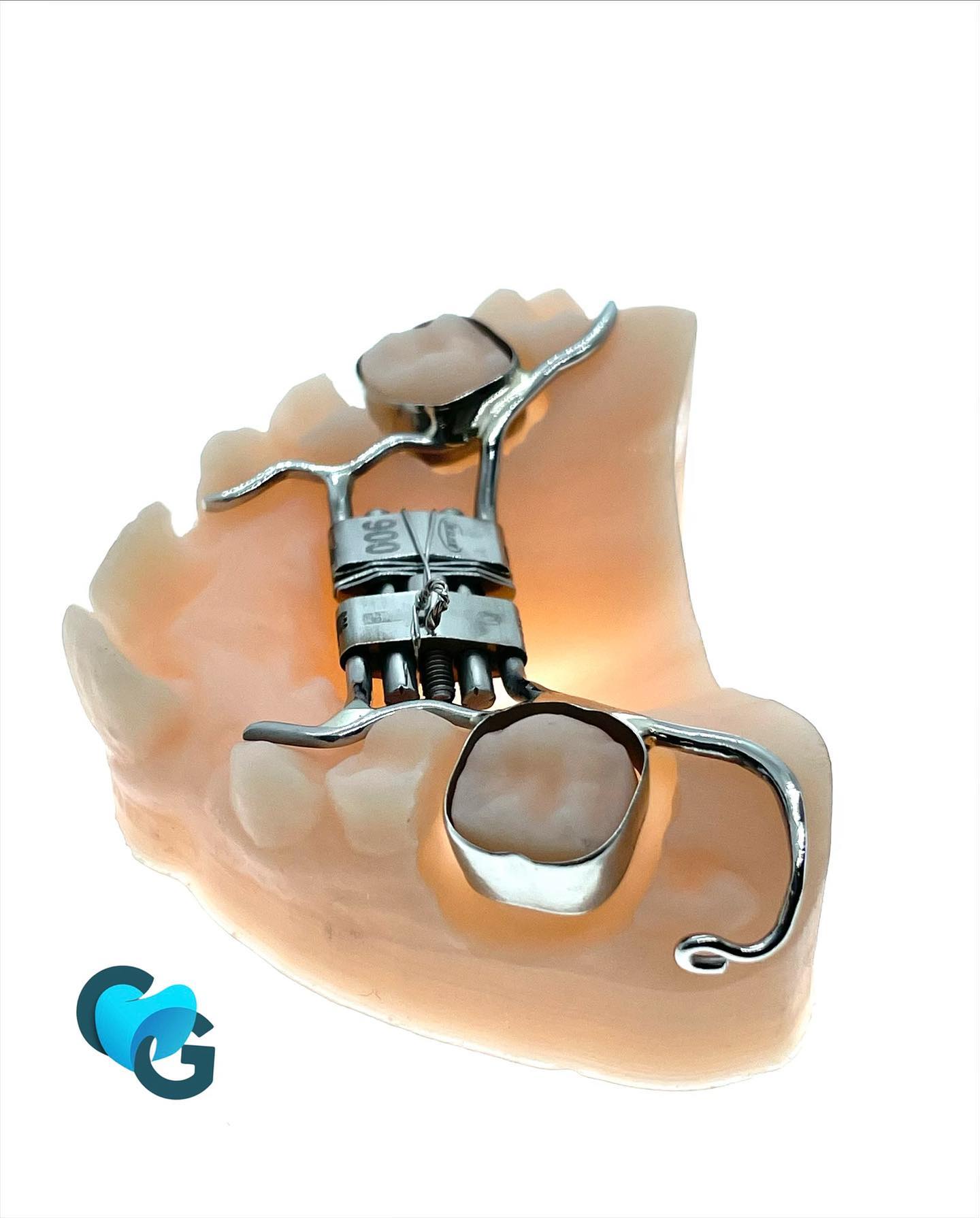 #leaf #leafexpander #expansion #expansionforcee #dent #ortho #orthodontie #dentiste #dentition #traitementdentaire #malposition #malpositionteeth #labodentaire