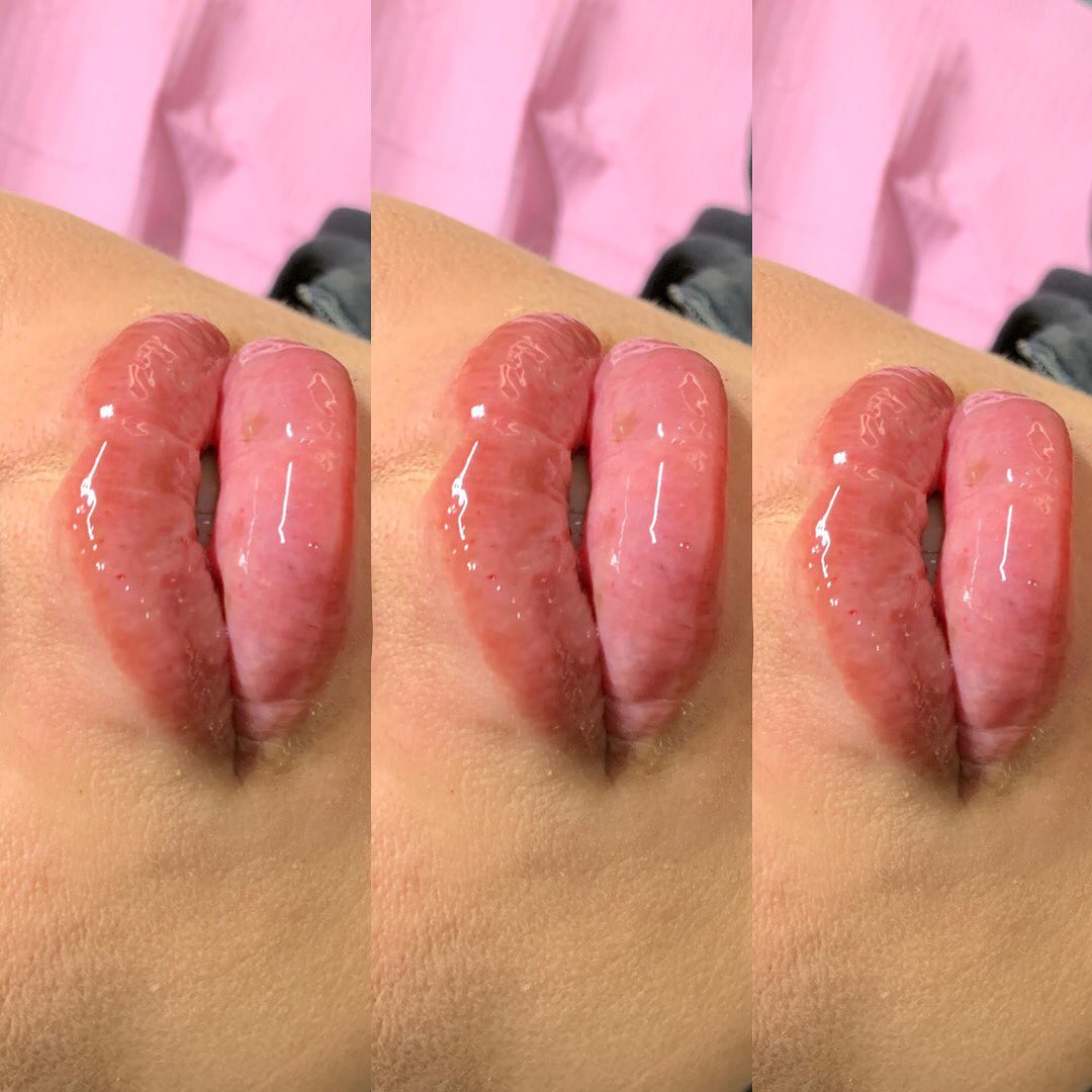 2ML was injected using the NO NEEDLE PENโผ๏ธ ZERO PAIN โผ๏ธ LONGLASTINGโผ๏ธโผ๏ธ $200 lip lash combo for black Friday book now!!! #explorepage #hyaluronpenusa #hyaluronpen #noneedlefiller #chinfiller #jawfiller #facialbalancing #lips #bradentonlips #miamilipfiller #tampalipfiller #tampalashes #bradentonlashes #sarasotalashes #hyaluronpentraining #nails #hair #beautybloggers