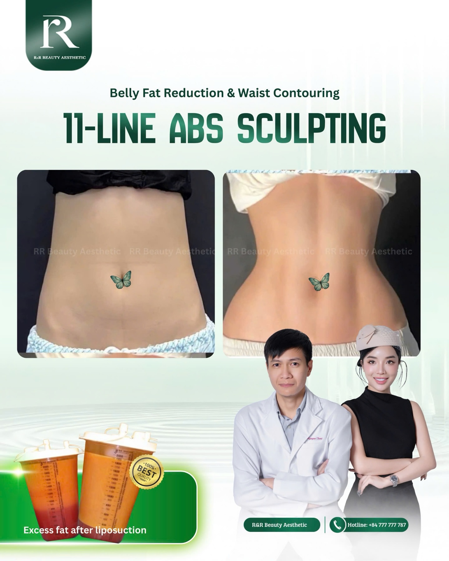 ✨ 11-LINE ABS SCULPTING | BELLY FAT REDUCTION & WAIST CONTOURING ✨
A defined waist isn’t about being skinny — it’s about clean lines, balance, and confidence.
🔥 RESULTS:
• Visible 11-line abdominal definition
• Slimmer, tighter waistline
• Flatter lower abdomen
• Smooth, natural contours
• Improved body confidence in fitted outfits
✨ Performed by experienced doctors with advanced body contouring techniques
✨ Safe, refined, and long-lasting results.
📍 Available exclusively at RR Beauty Aesthetic
📩 Message us for a private consultation
----
📞 Hotline: +84 777 777 787
👉 https://linktr.ee/rrbeauty.group
.
.
.
#11lineabssculpting #waistcontouring #bodycontouringclinic #rrbeautyaesthetic #absdefinition
11 line abs sculpting belly fat reduction waist contouring abdominal definition liposuction results body sculpting clinic rr beauty aesthetic