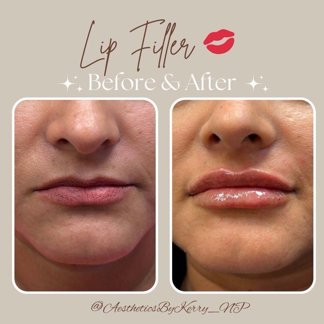 Fresh off the needle 💉✨💋
.
.
.
#lipfillerbeforeandafter #hydratedlips #perfectpout #southfloridainjector
