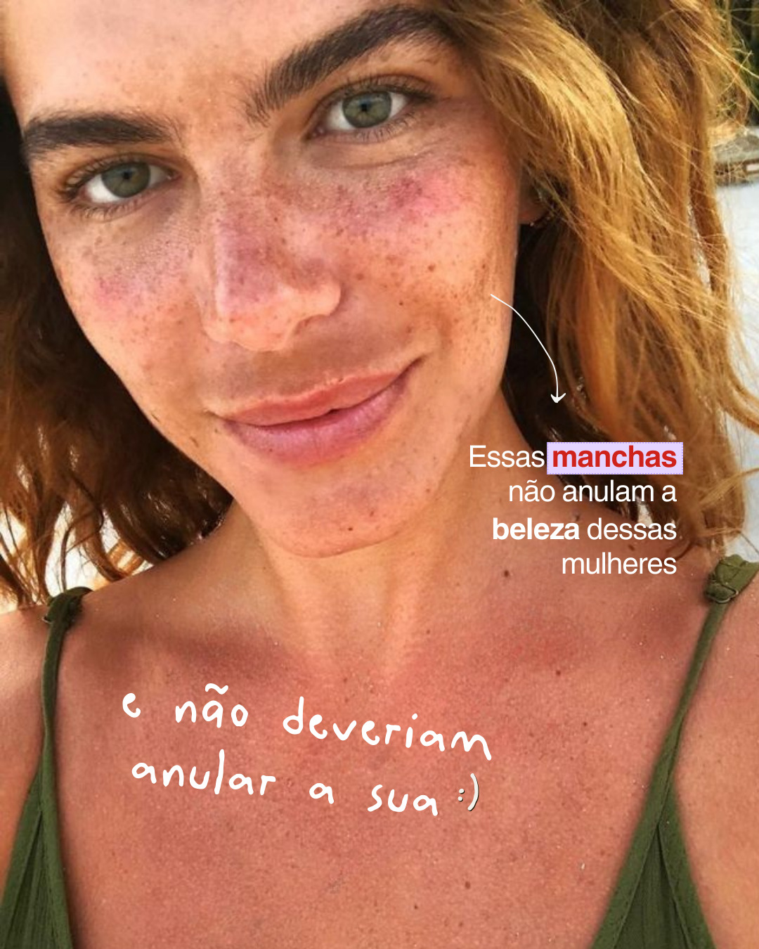 Melasma não tem cura definitiva, mas tem controle. E no verão, o cuidado precisa ser ainda mais rigoroso.
Você lida com o melasma? Me conta, qual o seu maior desafio na rotina de cuidados?
Dra. Gabriela Noronha
CRM 177979 | RQE 80095