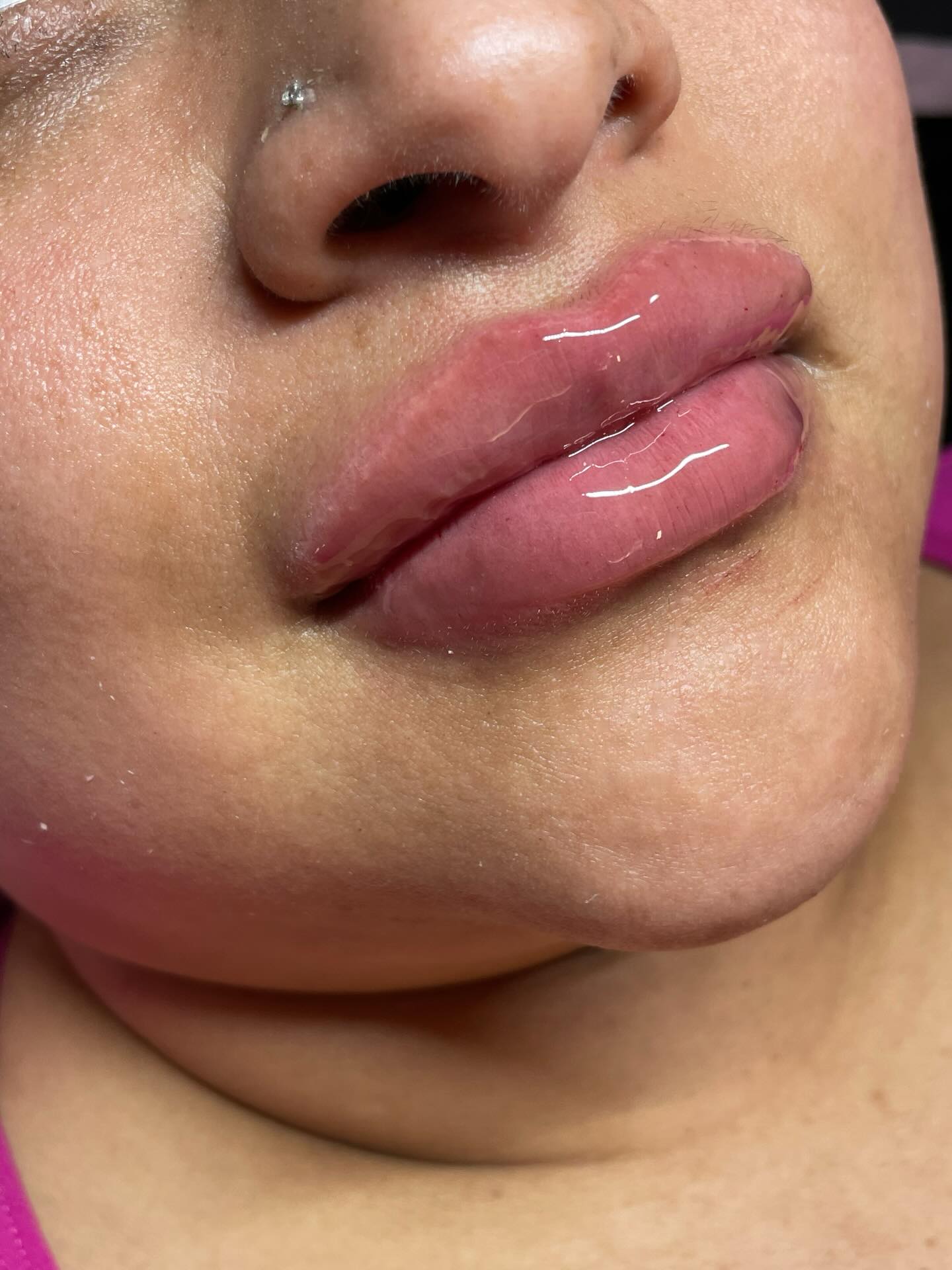 2mL injected into my beautiful client using my microneedling technique 💕😍 #lipfillers #fillers #facialbalancing #lashes #hyaluronpen