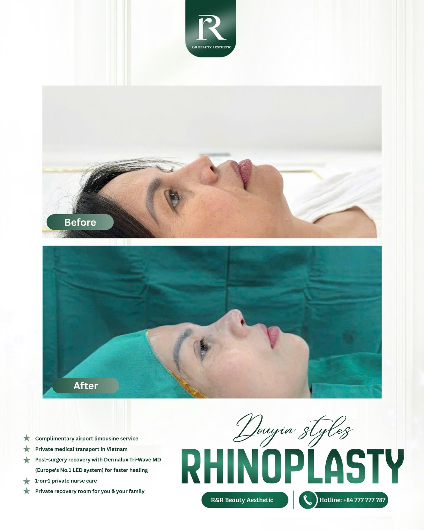✨ RHINOPLASTY – FOR FEMININE ELEGANCE
1️⃣ A naturally elevated nose bridge that fits your facial proportions
2️⃣ Refined nose tip with soft definition — no stiffness, no overdone look
3️⃣ Balanced side profile that instantly enhances feminine elegance
4️⃣ Reduced swelling & faster recovery with European Dermalux light therapy
5️⃣ Long-lasting results with stable structure and natural movement
💎 WHY RR BEAUTY AESTHETIC?
✔️ Performed by experienced specialist doctors
✔️ Advanced gentle technique – minimal pain, minimal swelling
✔️ European recovery technology for faster healing
✔️ 1-on-1 private care throughout the journey
✔️ International-standard clinic with hospital-level safety
📩 Limited consultation slots available – DM RR Beauty to book yours.
.
.
#rhinoplasty #naturalnose #feminineelegance #rrbeautyaesthetic #nosejobresults
rhinoplasty vietnam natural rhinoplasty feminine nose design expert nose surgeon fast recovery nose surgery rr beauty aesthetic premium rhinoplasty clinic