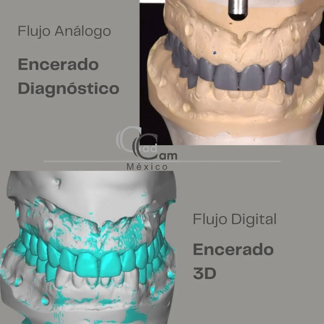 El encerado diagnóstico tradicional es una obra maestra en el mundo dental. Los profesionales esculpen manualmente cada detalle en cera, brindando una visualización táctil y visual del resultado esperado. Aunque es un proceso apreciado por su meticulosidad, puede presentar desafíos en términos de tiempo y replicación exacta.
¡Bienvenido al futuro con los encerados 3D de CAD CAM México! Esta técnica vanguardista aprovecha la potencia del diseño asistido por computadora (CAD) para crear modelos virtuales precisos. Cada contorno, cada detalle es esculpido digitalmente, permitiendo una visualización tridimensional realista y una personalización sin precedentes. Los encerados 3D enriquecen la planificación, aceleran los procesos y ofrecen una precisión milimétrica. - - - Aviso de responsabilidad: Todas las fotos publicadas en esta cuenta de Instagram son propiedad intelectual de Estudio de Porcelana Suizo S.A de C.V. y están protegidas por derechos de autor. #CadCam #Mexico #Cromocobalto #implantologia #implantesdentales #dentistry #dentista