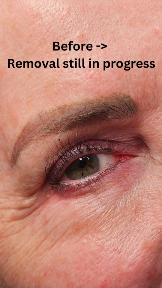 ๐ฉ Do you have botched eyebrows?
Saline Tattoo Removal to the rescue!!!
This isnโt just a before/after โ itโs healing in motion๐
Want more removal breakdowns, tips, and honest insights? Drop a ๐ฌ below!
@liftinkremoval #BrowRemoval #MicrobladingRemoval #SalineRemoval #PermanentMakeupRemoval #botchedbrows