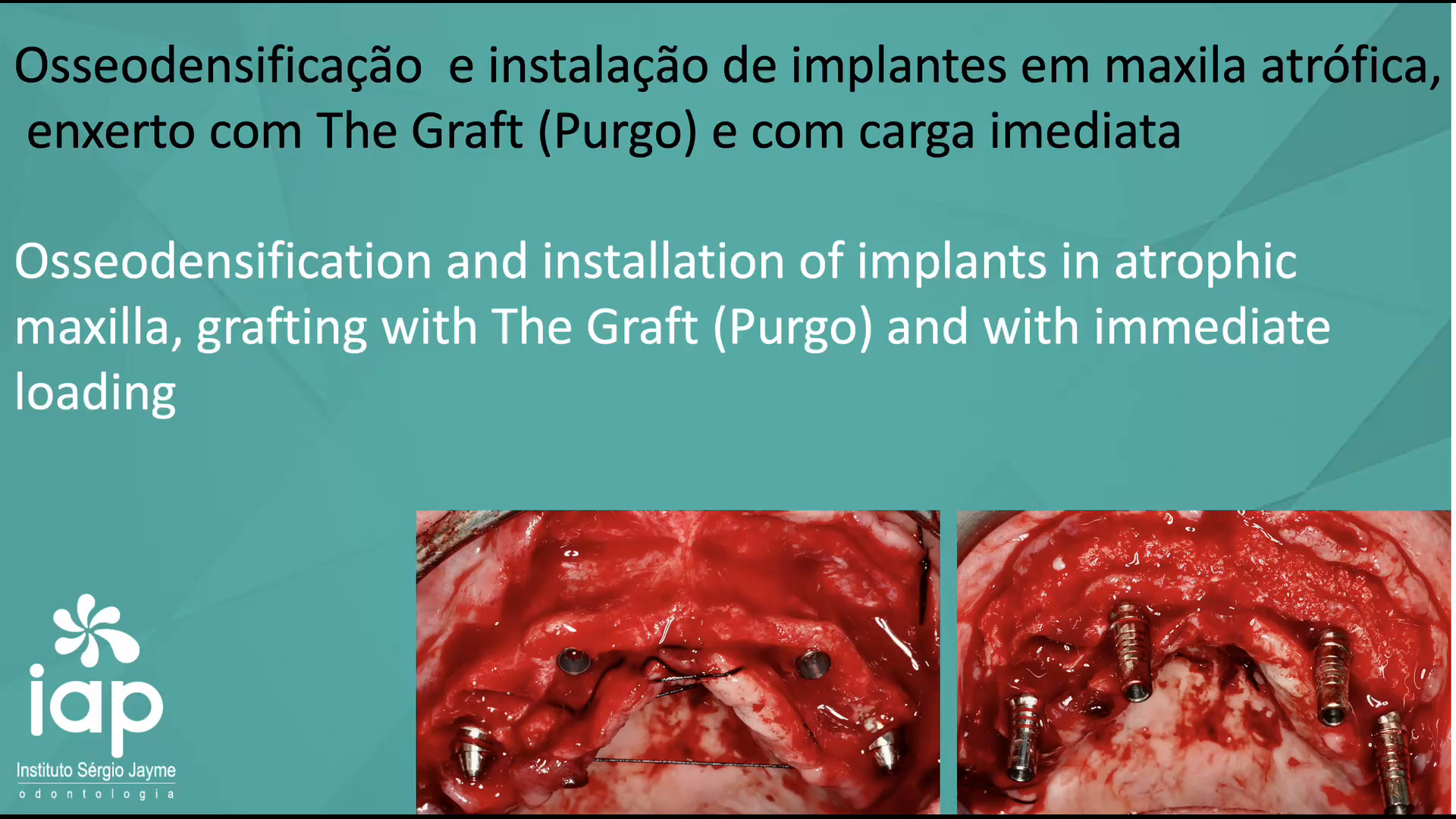 Osseodensificação e instalação de implantes em maxila atrófica,
enxerto com The Graft (Purgo) e com carga imediata
Osseodensification and installation of implants in atrophic
maxilla, grafting with The Graft (Purgo) and with immediate
loading
O planejamento inicial, protético e cirúrgico, resultará em sucesso ou fracasso no tratamento final do seu paciente.
O uso da osseodensificação é muito importante quando temos osso de baixa qualidade, assim, aumentamos a previsibilidade e o sucesso a longo prazo.
Devemos levar em consideração o número e posicionamento dos implantes. Esse cuidado é o que vai determinar a longevidade da nossa reabilitação devolvendo função e estética adequada aos nossos pacientes. Foram instalados 4 implantes superiores na técnica All on 4, que foram ativados com carga imediata.
Obs: Cirurgia realizada no Curso de Cirurgia Avançada do IAP
Dr. Sérgio Jayme
Av. Paulista, 91 Cj 402 Tel (11)5572-1283 / Cel e WhatsApp (11)94888-2000 CEP:01311-000 São Paulo-SP
Av. Rubem Berta, 1461 Tel (11)2276-2217 / Cel e WhatsApp (11)98383-3941 CEP: 04074-010 São Paulo-SP
#implante #periodontia #curso #rog #enxertoosseo #enxerto #iap #protesedental #protesedentaria #regeneracaoosseaguiada #cargaimediata #sergiojayme #sergiojaime #cienciaemvideo #implantesdentarios #implantes #implant #implants #implantdentistry #implantology #implantodontia #nobelbiocare #iapcursos #implantec