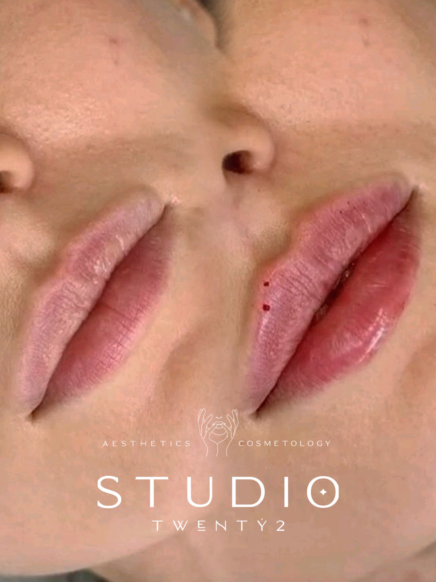 Valentine's ready ❤️💋
This Valentine’s we’re focusing on subtle enhancements that feel effortless and look completely natural. Thoughtfully placed filler to restore hydration, balance proportions and gently enhance your natural shape without overfilling or distortion 🤍
Limited Valentine’s appointments available. Book online or Message for availability.
#StudioTwenty2 #LipFiller #NaturalLips #LipEnhancement #ValentinesGlow SubtleAesthetics FreshFace NorthEastAesthetics SoftVolume ConfidenceBoost