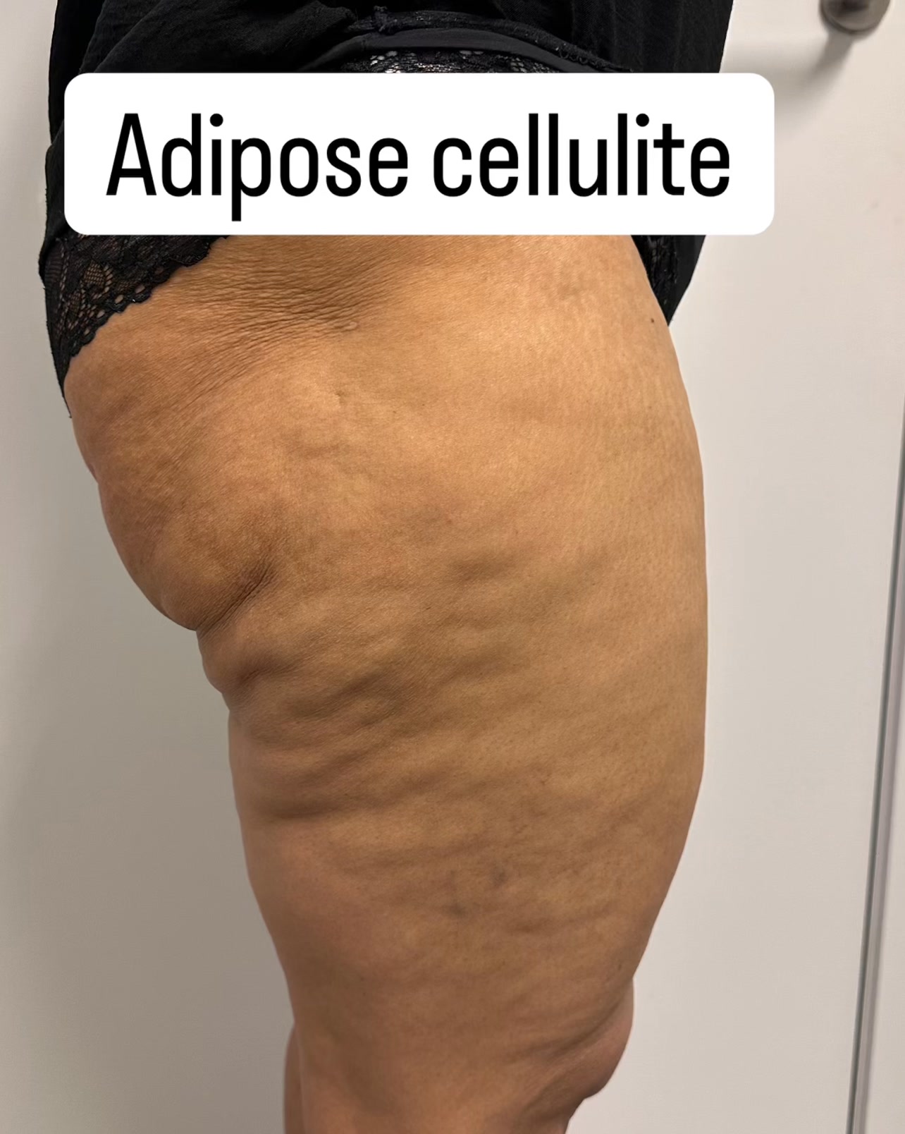 Adipose cellulite
verwijst naar cellulite die vooral wordt veroorzaakt door een ophoping van vetcellen onder de huid. Deze vorm van cellulite komt vaak voor op de dijen, billen, buik en heupen en geeft de huid een bobbelig of “sinaasappelhuid”-uiterlijk.
📍Kenmerken:
Zachte, vaak minder pijnlijke cellulite
Meer zichtbaar bij knijpen of aanspannen
Geassocieerd met vetophoping en verminderde doorbloeding
📍Aanpak:
ReCell radiofrequentie werkt diep in op de huid en het onderliggende vetweefsel, waardoor adipose cellulite effectief en veilig wordt aangepakt.
📍 Zo werkt het:
🔥 Stimuleert vetmetabolisme: activeert de vetcellen en helpt bij het verminderen van vetophopingen.
🔄 Verbetert doorbloeding & lymfedrainage: voert afvalstoffen en vocht sneller af.
💪 Verstevigt de huid: stimuleert collageen- en elastineproductie voor een strakkere huid.
🧬 Celstimulatie op 448 kHz: bevordert celherstel en -vernieuwing zonder de huid te beschadigen.
📍Resultaat:�
Een gladdere huid, zichtbaar minder cellulite en verbeterde huidstructuur, vooral ter hoogte van dijen, billen en buik.
#RFenergie #radiofrequentie #indiba448khz #cellulitebehandeling #huidversteviging #vetreductie #huidverbetering #bodycontouring #strakkerehuid #professioneletechnologie #recellrf