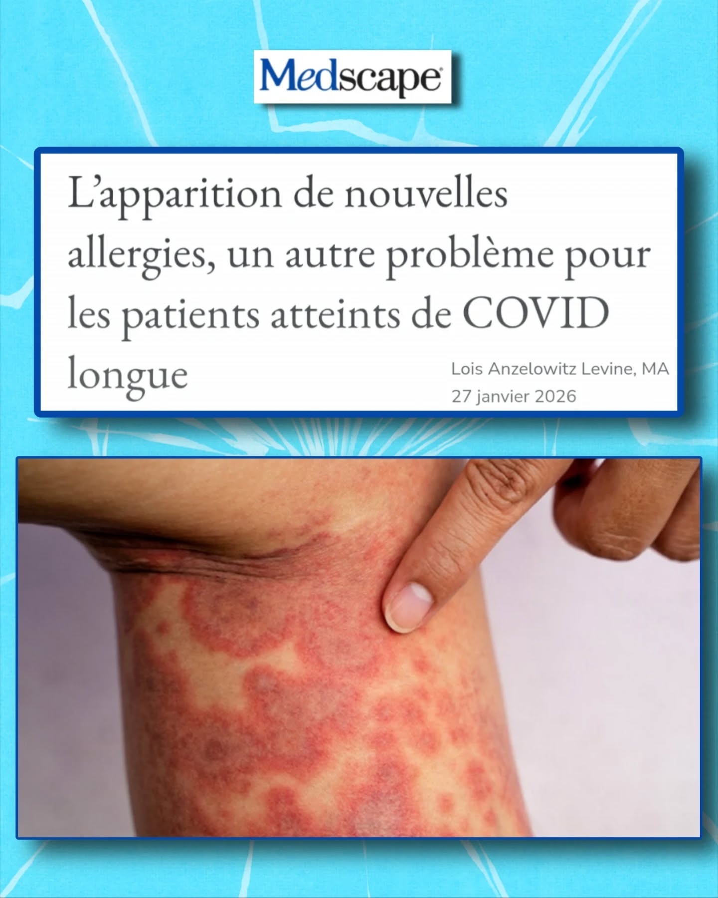 🧵#CovidLong : nouvelles allergies, asthme, intolérances➡️un signal d’alarme immunologique
De plus en plus de patients développent après une infection au SARS-CoV-2 :
- Asthme
- Rhinite allergique
- Allergies alimentaires
- Hypersensibilités chimiques
🔬Le point de départ : un dérèglement immunitaire persistant
Une étude publiée dans Nature Immunology (déc. 2024) a comparé :
• Des patients guéris du #COVID aigu
• Des patients avec symptômes persistants (CovidLong)
Résultat chez les patients CovidLong :
• Inflammation chronique
• Épuisement immunitaire
• Altération du métabolisme énergétique cellulaire
🧠Ces anomalies créent un terrain propice à :
• L’hyperréactivité immunitaire
• La perte de tolérance
• Les réactions allergiques et pseudo-allergiques
Le système immunitaire ne revient pas à l’équilibre.
🗣️Malika Boudries, PhD (Harvard) :
« Il est plausible que l’infection par le SARSCoV2 contribue à une augmentation des réactions allergiques. »
Elle précise que cette hypothèse est étayée par :
• L’auto-immunité postCOVID
• La réactivation de virus latents comme l’EBV
🧬 Dans le CovidLong, on observe fréquemment :
• Une production persistante de cytokines pro-inflammatoires
• Un dérèglement des lymphocytes B & T
• La formation d’auto-anticorps
Ce contexte favorise l’émergence de maladies allergiques et atopiques.
📊Données populationnelles massives (États-Unis)
🔍Étude publiée dans le Journal of Allergy and Clinical Immunology
Analyse de dossiers médicaux électroniques de plus de 118 millions de patients
Après une infection au SARSCoV2 :
• +74 % de rhinosinusite chronique
• +66 % d’asthme
• +37 % de rhinite allergique
⚠️ Ces diagnostics sont nouveaux, pas de simples aggravations.
L’infection agit comme un déclencheur biologique.
💉Vaccination : un effet protecteur clair
Chez les personnes vaccinées mais non infectées :
• Risque significativement plus faible d’asthme
• Risque plus faible de rhinosinusite chronique
• Risque légèrement réduit de rhinite allergique
⏬Suite en commentaire ⏬
#LongCovid #MCAS #SAMA @putrino_lab @monicavgutierrez @assomast.fr