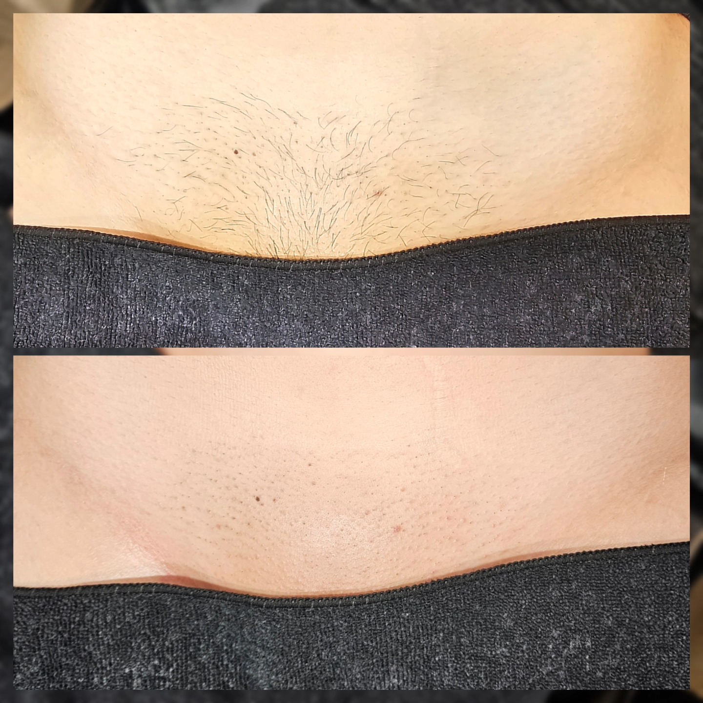 Signature Brazilian Wax 🤌✨ For elite smoothness!
She's got some slow growth coming in just under the surface after maintaining for months, along with thinner more sparse regrowth. Love to see it!
This guest will be starting Accutane after this appointment, which means she won't be able to get waxed again while on the medication and 6-12 months thereafter due to how sensitive the skin can be, which could cause major lifting (OUCH!) This is why filling out your Forms and updating your Esthetician/service provider is so important!