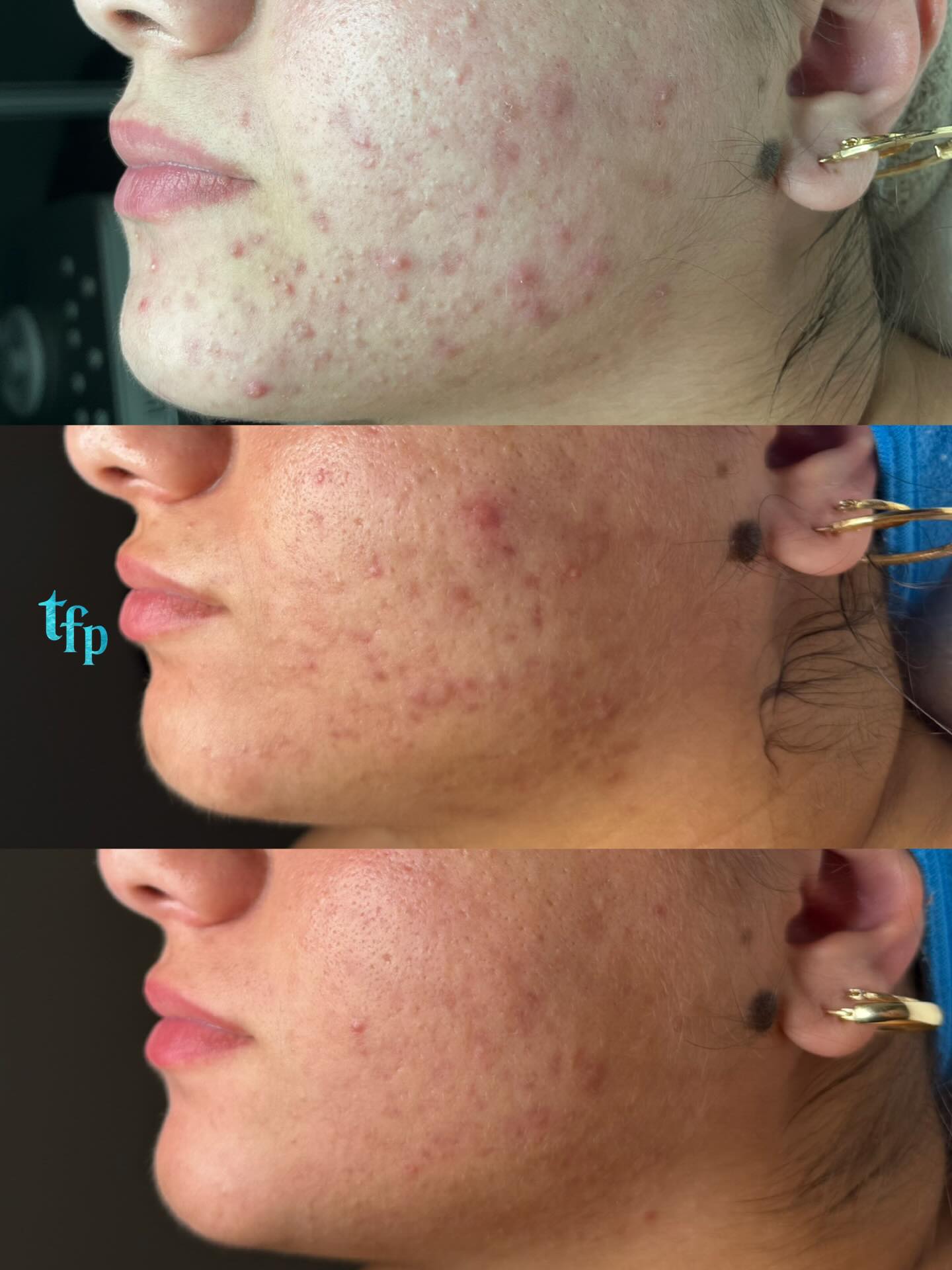 Progress with your skin isn’t always linear. Sometimes it can look a little worse for a couple months before it gets better, but that doesn’t mean cellular change isn’t happening 🩵
This is a 6 month bootcamp transformation. It took a little longer because sticking to an acne-safe diet while having a super busy schedule and going back and forth between school lunches vs at home lunches can be very challenging. Also, some people’s acne may just be more stubborn than others, especially non inflamed bumpy acne which can be the hardest to clear.
I’m so proud of this client for sticking with her routine, continuing to make acne safe lifestyle and diet swaps and trusting me 🫶🏼 progress over perfection always!
If you’re ready to finally get on track to clear your skin book an Acne Facial with me on thefaceplacemi.com