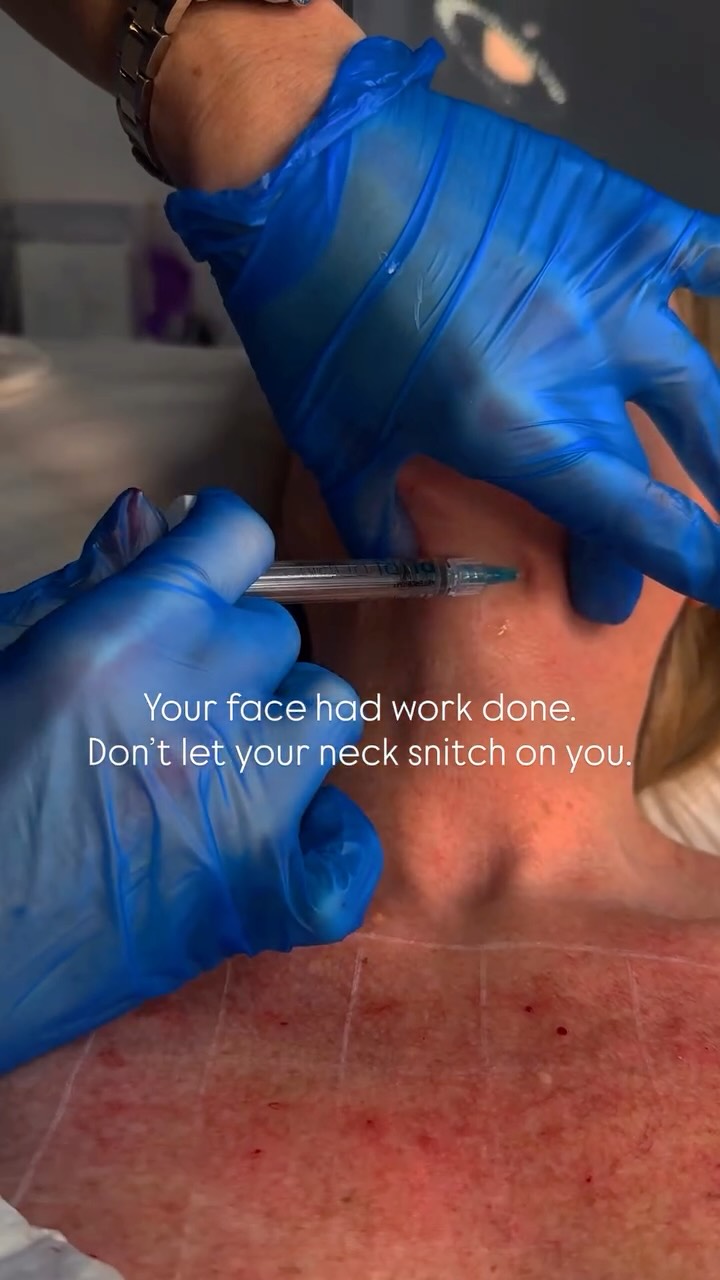 Your face had work done…
don’t let your neck snitch on you.
The neck is often the first place to show ageing unfortunately! Thinner skin, less collagen, constant movement especially looking at our phones.
So even when the face looks fresh, the neck can quietly give the game away and look even more aged next to your freshly treated face.
Polynucleotides are a game changer - the salmon DNA work at a cellular level to repair, strengthen and regenerate the skin.
This improves texture, firmness and elasticity over time.
If you’ve noticed aging and a loss of skin firmness then this treatment is for you!
Get in touch via DM or hit the link in our bio to discuss treatment options.