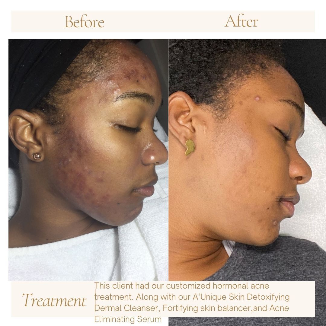 Using AâUnique Skin skincare products offers a range of impressive benefits:
1. Improved Skin Texture and Clarity- The products help refine skin texture, resulting in a smoother and more even complexion.
2. Deep Hydration- Formulated with potent hydrating ingredients, the products provide long-lasting moisture without greasiness, leaving skin plump and supple.
3. Anti-Aging Properties- Rich in antioxidants and anti-aging compounds, the skincare line reduces the appearance of fine lines and wrinkles, promoting a youthful look.
4. Natural Ingredients - AâUnique Skin prioritizes high-quality, natural ingredients that nourish and protect the skin, minimizing the risk of irritation and adverse reactions.
5. Radiant Glow- Regular use results in a healthy, radiant glow, as the products enhance skin's natural luminosity.
6. Targeted Solutions- The range addresses specific skin concerns such as dryness, acne, and hyperpigmentation with effective, targeted formulations.
7. Enhanced Resilience- Strengthens the skin barrier, making it more resilient against environmental stressors and reducing sensitivity.
8. Luxurious Experience- The thoughtfully crafted products offer a luxurious skincare experience,
combining efficacy with indulgence.
Overall, AâUnique Skin skincare products deliver visible improvements and long-term benefits, making them an excellent choice for achieving and maintaining healthy, beautiful skin.
#skincare #skincareroutine #skincareproducts #correctiveskincare #hormonalacne #glowingskin #antiaging #cosmetics #healthyskin #skincareresults #women #beauty #acne #rosacea #naturalskincare #men #ftlauderdaleesthetician #coralspringsesthetician #broward #coralsprings #ftlauderdale #tamarac #esthetician #parkland #miami #broward #northlauderdale #boca #Aunique skin