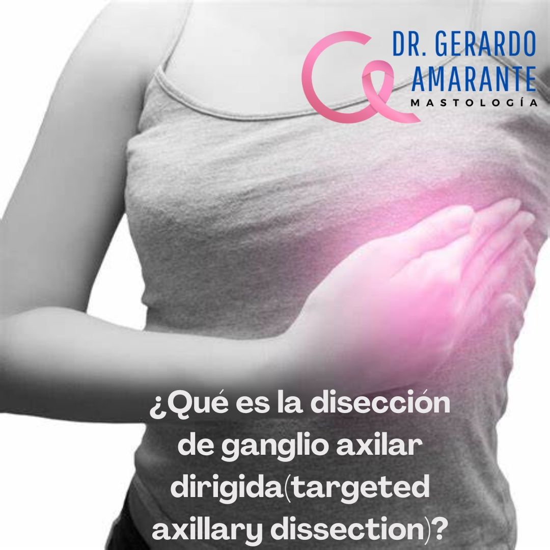 En ocasiones cuando se diagnostica un cáncer de mama que ya alcanzó uno de los ganglios de la axila, decidimos dar quimioterapia antes de operar y posteriormente se realiza este procedimiento que consiste en retirar los ganglios centinela más el ganglio que se conocía con cáncer. Si la quimioterapia logra erradicar el cáncer del ganglio, entonces es seguro no realizar una disección axilar completa y así reducimos las consecuencias de un procedimiento tan radical.
🥼 Dr. Gerardo Amarante
📍Centro de Cáncer de Mama Hospital Zambrano Hellion
📍GAMA Medicina de Alta Especialidad Col. Obispado
📍Hospitaria Hospital
☎️ Citas y Whatsapp 8115552813
#mastologo #cirugiademama #cancerdemama #mastologia #cancer #mastectomia #reconstrucciondemama #cirujanoespecialistaenmama #biopsiademama #oncologia #consultademama #cirugiaoncoplastica #octubrerosa #segundaopinion