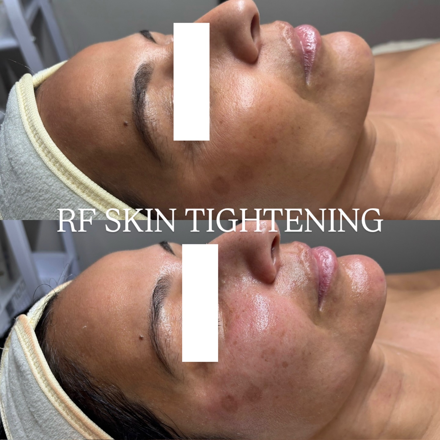Skin tightening without needles. Results you can see.
This is Radio Frequency (RF) skin tightening with Geneo — and the before & after says it all.
✨ Notice the eye area: smoother, plumper, more lifted
✨ RF gently heats the deeper layers of the skin
✨ Stimulates collagen + elastin production
✨ Improves fine lines, laxity, and overall firmness
✨ Instant glow with long-term tightening benefits
That plump, refreshed look around the eyes?
That’s collagen waking up 🔥
Perfect for clients who want:
• Firmer skin
• A lifted, rested appearance
• Non-invasive anti-aging
• Zero downtime
Your skin, but tighter 💫
𝘔𝘺 𝘉𝘦𝘢𝘶𝘵𝘪𝘲𝘶𝘦
📧info@mybeautiqueinc.com
☎️416 399 6388
🖥️www.mybeautiqueinc.com
#Geneo #GeneoRF #SkinTightening #CollagenBoost #NonInvasiveLift UnderEyeRejuvenation SkinFirming AdvancedSkincare BeforeAndAfter EstheticResults