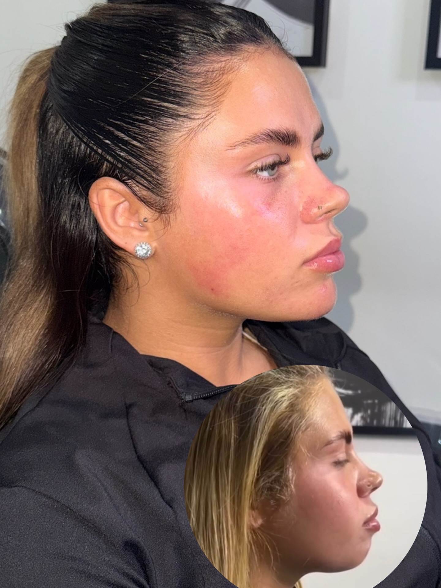 Proof that small tweaks can make a big difference. Before ➡️ After ✨
Chin filler doing what it does best💉😮💨
#chinfiller #aesthetics #aestheticspractitioner #beforeandafter