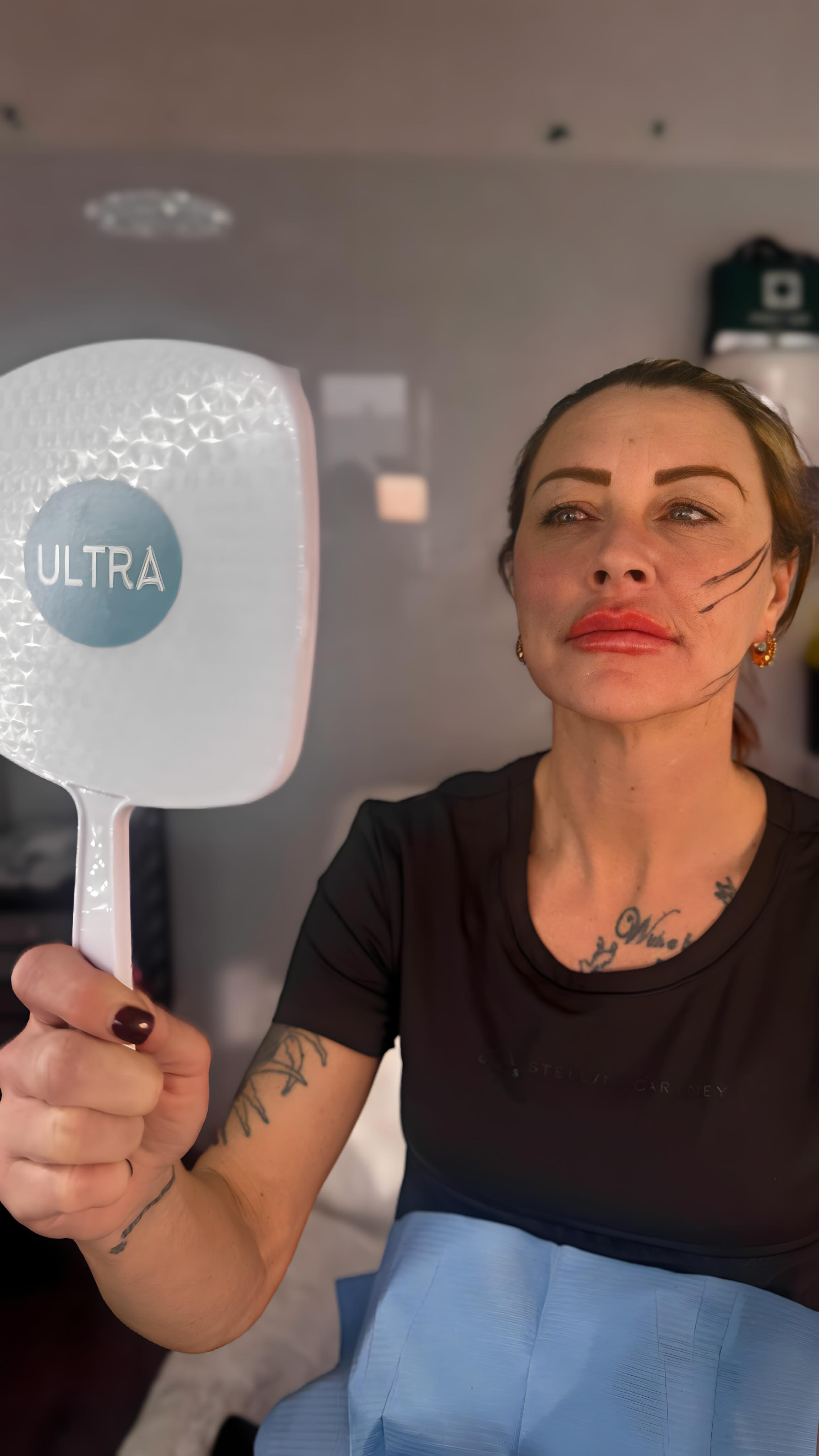 Can you make me feel like me again - Absolutely! 💯
This transformation combines PDO threads to lift and support the face, with subtle lip filler to restore balance (lips are fresh of the needle and swollen here) , results will settle over the coming days.
No overfilling.
No drastic tweaks.
Just bringing everything back into alignment.
Because feeling like yourself again is always the goal.
If you’re looking in the mirror and feel a little disconnected from what you see, let us help.
📲 DM for more information
🗓️ Book a consultation via the link in our bio
📞 WA +44 7511 685 627
📍 Ultra Aesthetics, UK