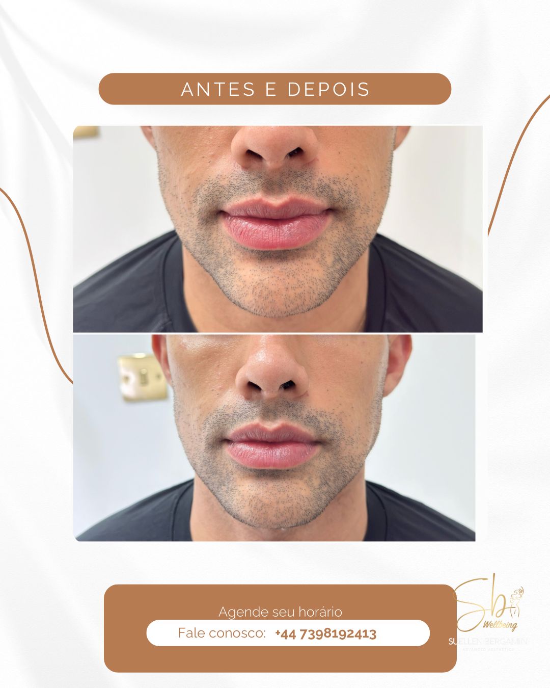 Harmonização Facial Masculina
✨ Bigode chinês + Queixo + Mandíbula
A harmonização facial masculina é pensada para valorizar os traços, sem perder a identidade.
Nada de exageros. Porque eu sei que eles querem equilíbrio e naturalidade.
E tudo começa com uma avaliação personalizada, respeitando a anatomia e o estilo de cada homem.
Resultado?
Um rosto mais harmônico, forte e alinhado com quem você é. 😍
📲 Agende seu horário: +44 7398 192413
.
Male Facial Harmonization
✨ Nasolabial folds + Chin + Jawline
Male facial harmonization is designed to enhance your features without losing your identity.
No exaggeration. Because I know men want balance and natural-looking results.
And it all starts with a personalized assessment, respecting the anatomy and style of each man.
The result?
A more harmonious, stronger face that truly reflects who you are. 😍
📲 Book your appointment: +44 7398 192413