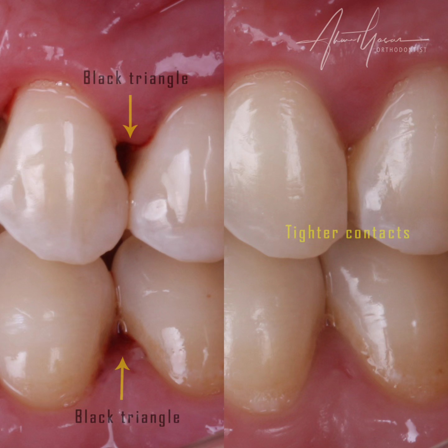 You may see black triangles between teeth when there is bone resorption and high contact point.
We can do stripping on contacts and bring the teeth closer. This way gingiva would fill better between teeth and eliminate black triangles.
.
Our clinic is authorized by the Ministry of Health of the Republic of Türkiye for International Health Tourism. All patients have been informed and have provided consent for the use of their photographs on our social media platforms. All content shared on social media is intended to inform patients about procedures and should not be perceived as advertising. Outcomes of any surgical or interventional treatment may vary from person to person. It is recommended to consult your physician for detailed information before undergoing any procedure.
.
.
.
#ortodonti #ortodontist #bursa #fsm #bursaortodonti #bursaortodontist #bursaortodontiuzmanı #orthodontics #braces #teltedavisi #orthognathicsurgery #invisalignbursa #şeffafplak #lingualortodonti #dişteli #çeneameliyatı #selfligating #kapaklıbraket #gülüştasarımı #dent #dentistry #photography #estetik #dentalart #ahmetyasar #drahmetyasar