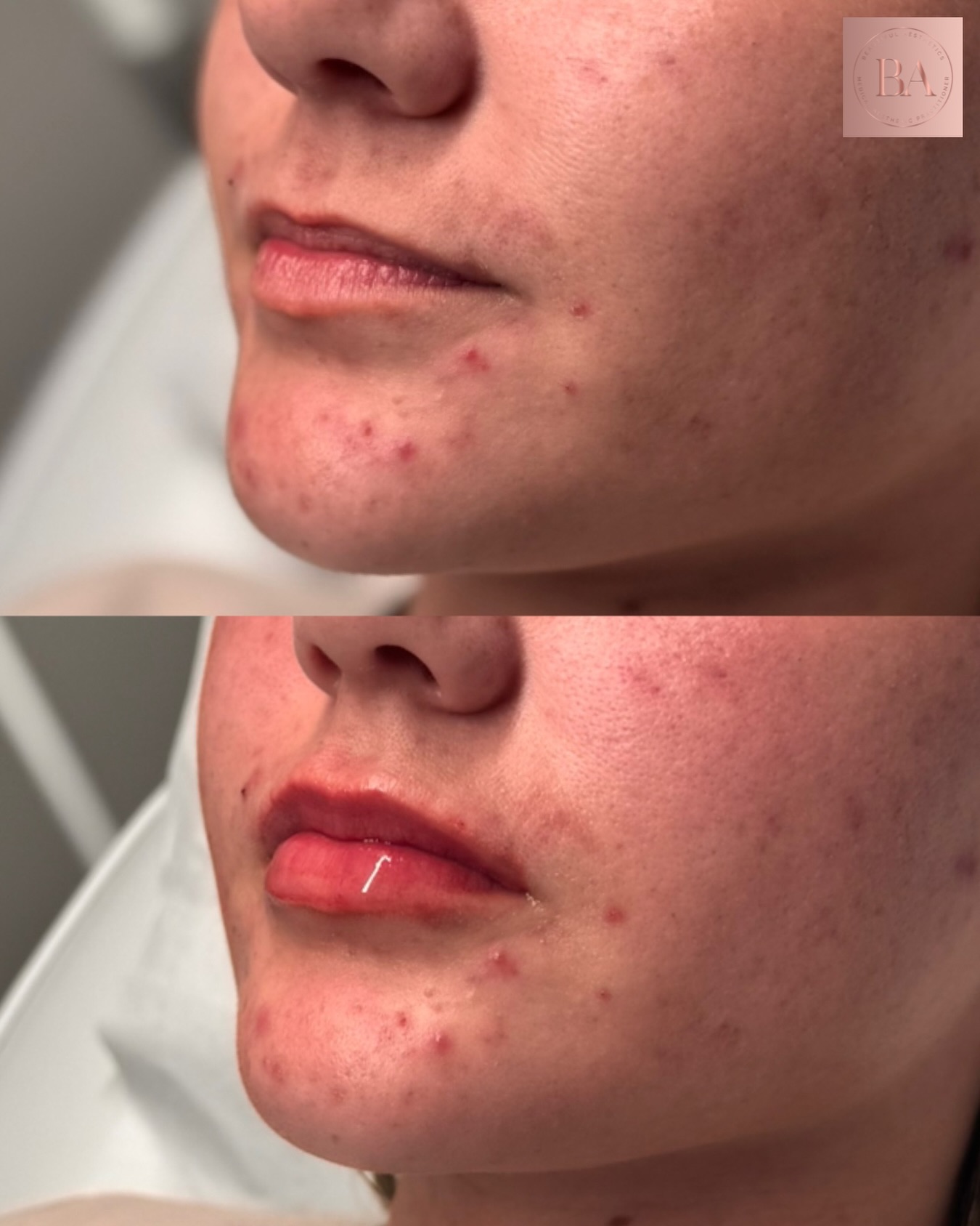 “She’d been considering lip filler for years… but fear held her back.”
Like so many patients, she loved the idea of hydrated, balanced lips — but worried about overfilled, unnatural results.
We’ve all seen the horror stories, and doing the research before trusting someone with your face matters.
After taking her time, she chose a practitioner who prioritises natural results, symmetry, and subtle enhancement — and most importantly, someone who listens.
From our initial consultation to treatment day, every step focused on:
✨ Understanding her concerns
✨ Discussing realistic, natural outcomes
✨ Creating soft, hydrated, balanced lips — never overdone
✨ A calm, comfortable experience in a clean, professional clinic
The result?
Lips that still look like hers — just refreshed, balanced and beautifully enhanced.
If you’ve been thinking about lip filler for a while but want to feel safe, heard, and confident in your choice, you’re not alone — and you’re in the right place.
📍 Beautiful Aesthetics, Cottingham
💉 Natural. Subtle. Thoughtfully done.
#NaturalLipFiller #SubtleEnhancements #TrustedAesthetics #PatientFocusedCare #BeautifulAesthetics