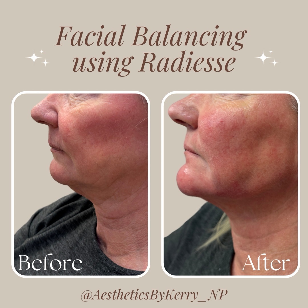 Chin support can change the entire balance of the face.
Her primary concern was marionette lines and nasolabial folds.
Rather than placing filler directly into those areas, treatment focused on cheek support, jawline reinforcement, and chin projection. Addressing facial support allowed those folds — and even the under-eye area — to improve naturally without isolated correction.
Book a consultation to explore whether facial balancing is the right approach for you.
👩🏼💻www.vitalhealing247.com
📍6279 W. Sample Rd. Suite 305
Coral Springs, FL. 33067
📲(954)-478-7225 for scheduling
.
.
.
#facialharmony #injectables #aestheticmedicine #naturalresults #antiagingtreatment