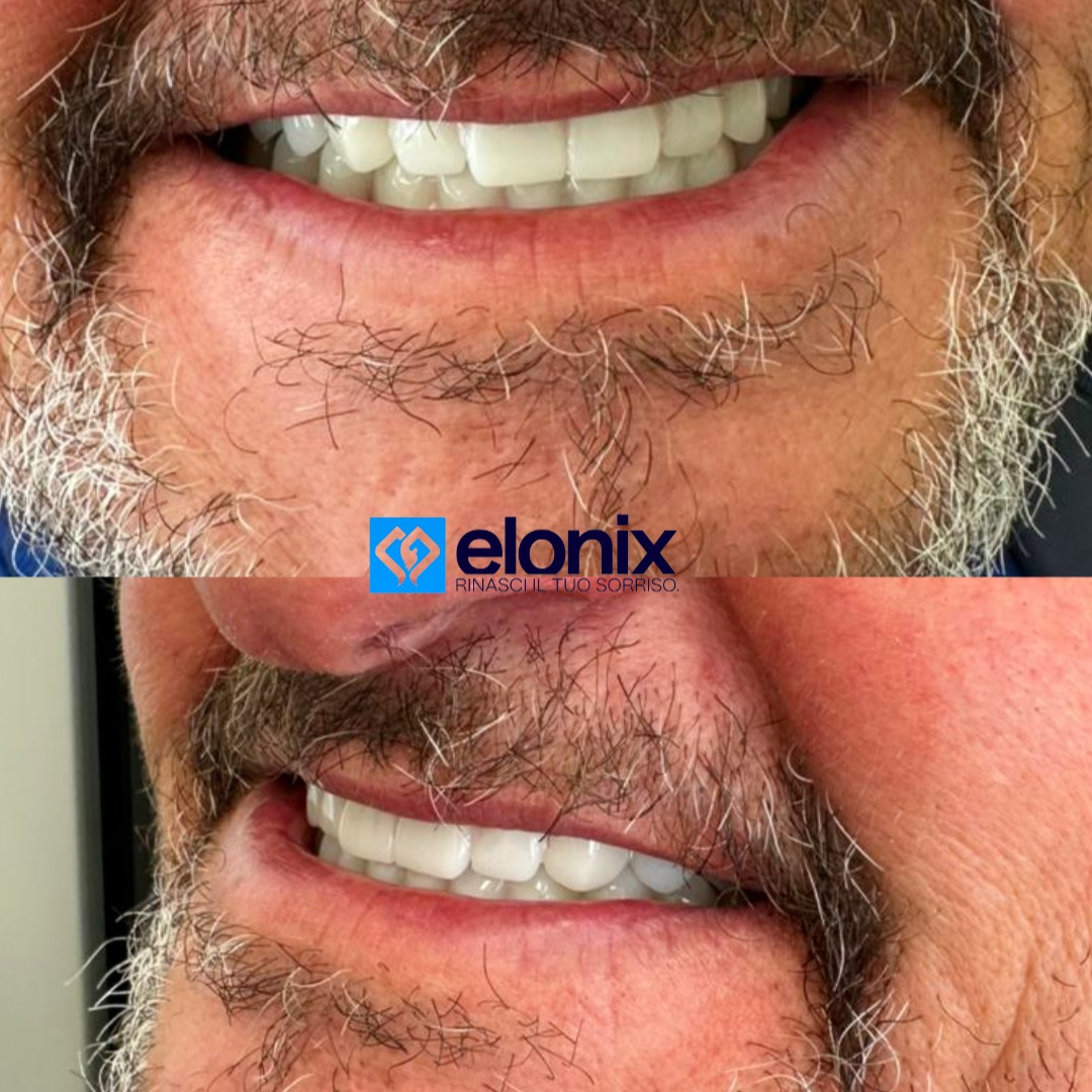#elonix #elonixdentalclinic #elonixclinic #chiurgiamaxillofacciale #elonix #elonixdentalclinic #elonixclinic #chiurgiamaxillofacciale #clinica #elonix #estetica #salute #denti #dentista #impianti #turismodentale #turismodentalealbania #turismodentaletirana #turismodentaletiranaalbania #zircone #tirana #dentalsurgery #dentalveneers #dentalwork #laboratoriodentale #panoramica #scaner3d🦷 #dentifissi #sorriso #dentalsolutionsisrael #dentistica #sorridere
