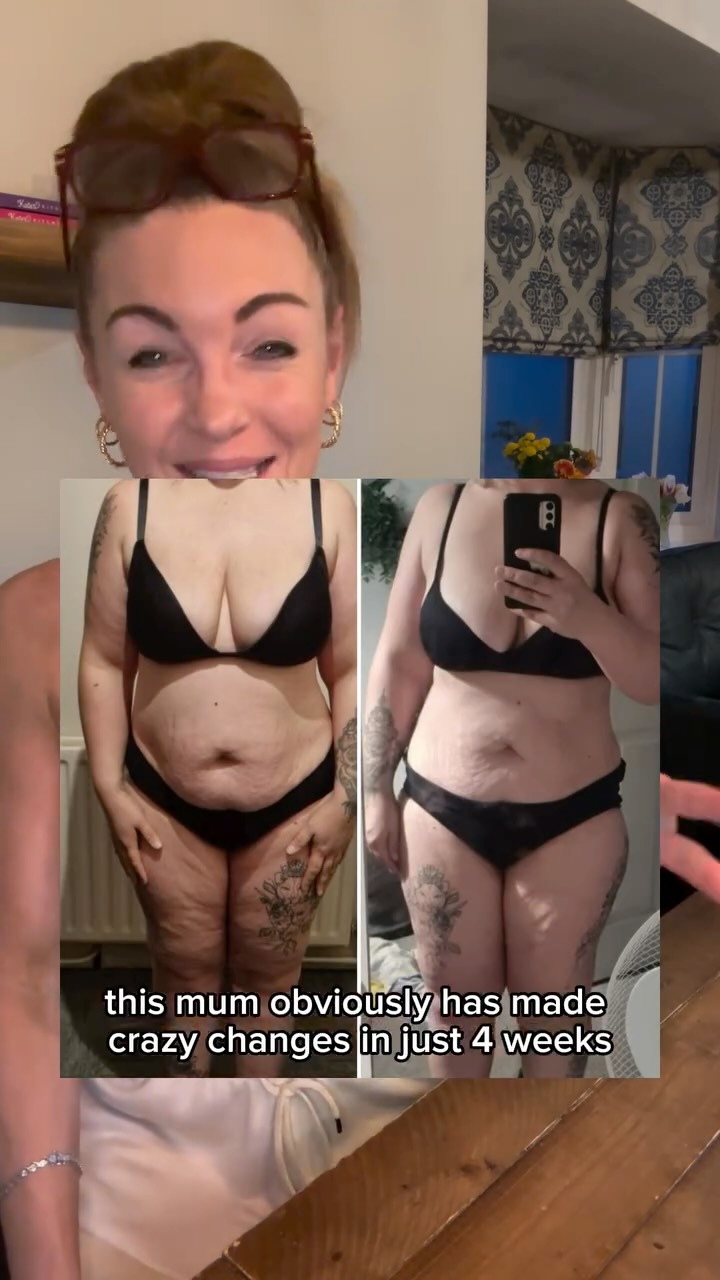😮💨 WATCH THIS if you struggle to see your body change…
Save this to refer back to - it could stop you from quitting!!!
4 weeks of exercise, and mum Kayleigh thought nothing had changed 😭
She just finished my RESET program - one workout 5x a week around working and caring for her autistic son 🫶 and you’ll agree - her body truly changed? 👀🥲….
And sadly, 99% of you who msg about your results, struggle to see your progress. But ladies if you’ve done the work, it’s there 🙌
Why do our brains self sabotage?👇
1. Negativity bias
Our brain scans for what’s wrong not what’s improved. It zooms in what we don’t like.
2. Hormone shifts blur your progress
Our body is so different from one day to the next - I would NOT be using the days where I’m bloated, full of food or hormonal to measure results 😱
3. Body dysmorphia
Even when your body changes it literally edits out the progress, and sees the previous mental Image of your body.
4. You see yourself daily - day to day change doesn’t SHOUT at you. We see it instantly, you can’t.
5. How you take and position your pictures are KEY!
Angles, clothes, distance from the mirror , how they’re positioned in the frame - it matters !
Photos land in my inbox most days where your brain absolutely cannot see a fair comparison because of what you’ve done with the photos. Send them to me!!
I see photos everyday it’s no biggie to me to - I can help you like I did Kayleigh - it’s often the boost you need not to quit.
You’re not failing. You’re often stressed, busy, exhausted & low in confidence, and your brain is lying to you 🫣
The progress is there if you’ve done the work 💯
Follow me to help you stop you focusing on flaws, and help you make the honest progress you deserve 💛
@kayleighhobbis you’re amazing, I’m so proud of you and I am excited your Core Builder journey 🔥!!
#katesmumfitclub #legsbumsandbubbas #workoutsformums #reallifemotherhood #maternalmentalhealth