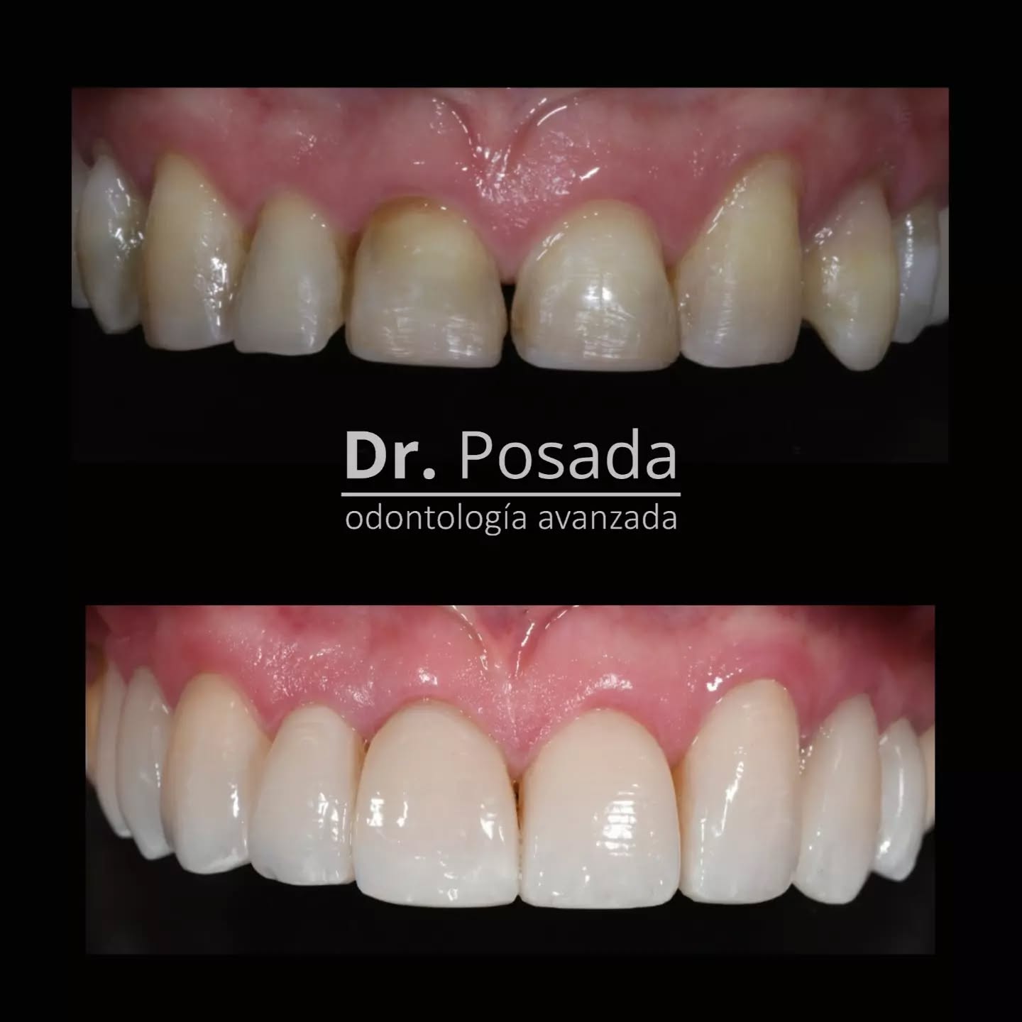 Diseño de sonrisa con laminados ceramicos, excelente alternativa para transformar tu sonrisa... y tu vida
.
🔝🇨🇴📲+57 3046529022
🔝🇨🇴☎️ 601 75552046
#agenda2023
#disponible
##agendatucita☎️📞 .
.
.
.
.
.
.
.
.
.
.
.
.
.
.
.
#smilemakeover #dentist #topdentist #topdenverrestaurants #diseñodesonrisa #colombiadentist #venners #bogota #carillas #naturalsmile #smilemakeover #lumineers #dsd #naturalsmile #sonrisa