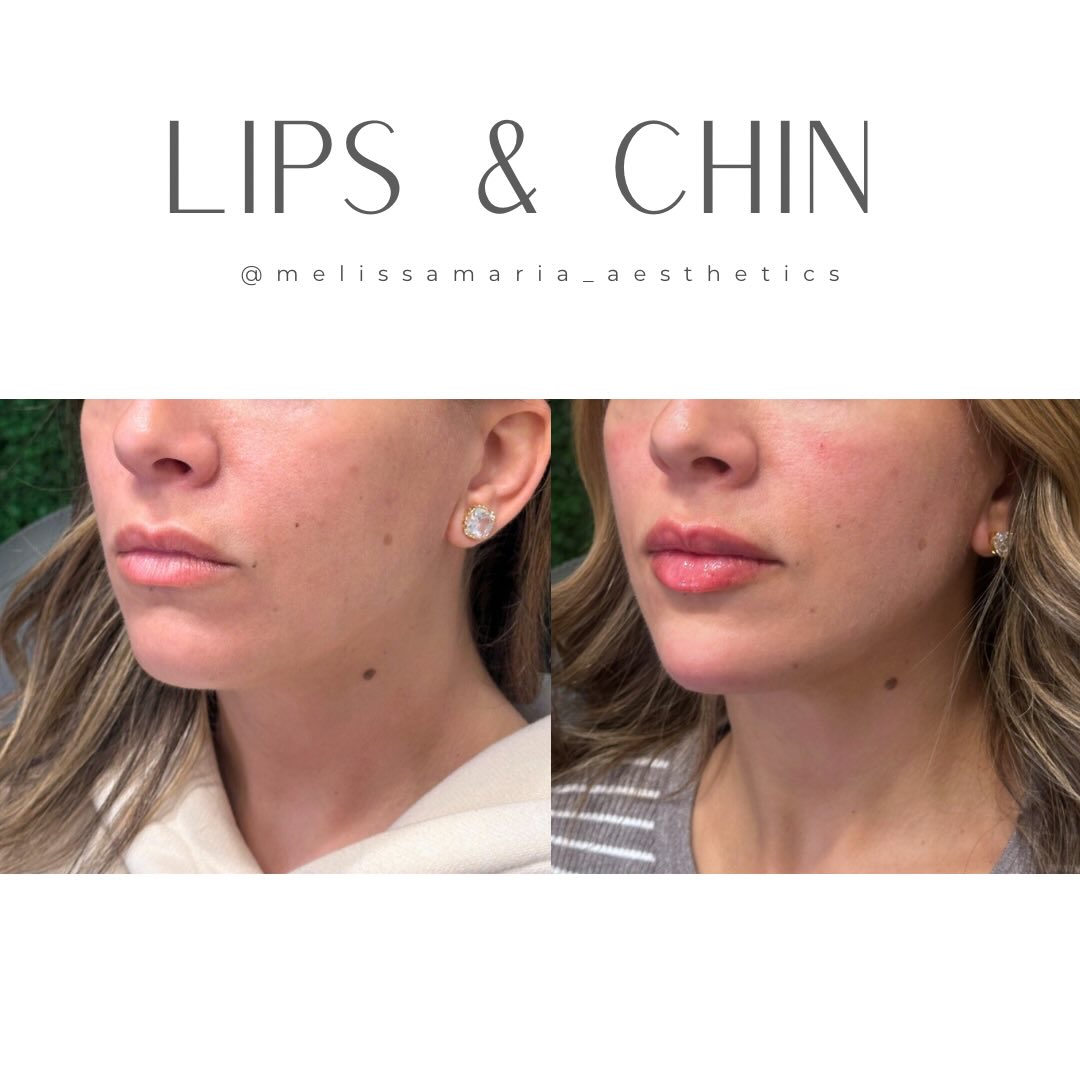 Many times I see chin corrections over done, leading to a witchy appearance or creating what I like to call a “stiletto chin”.
I’m hoping that trend dies soon!
What are your thoughts 💭?
#chinfillerraleigh #chinfillergreensboro #chinfillercharlotte
#lipfillerraleigh #lipsbymeli
