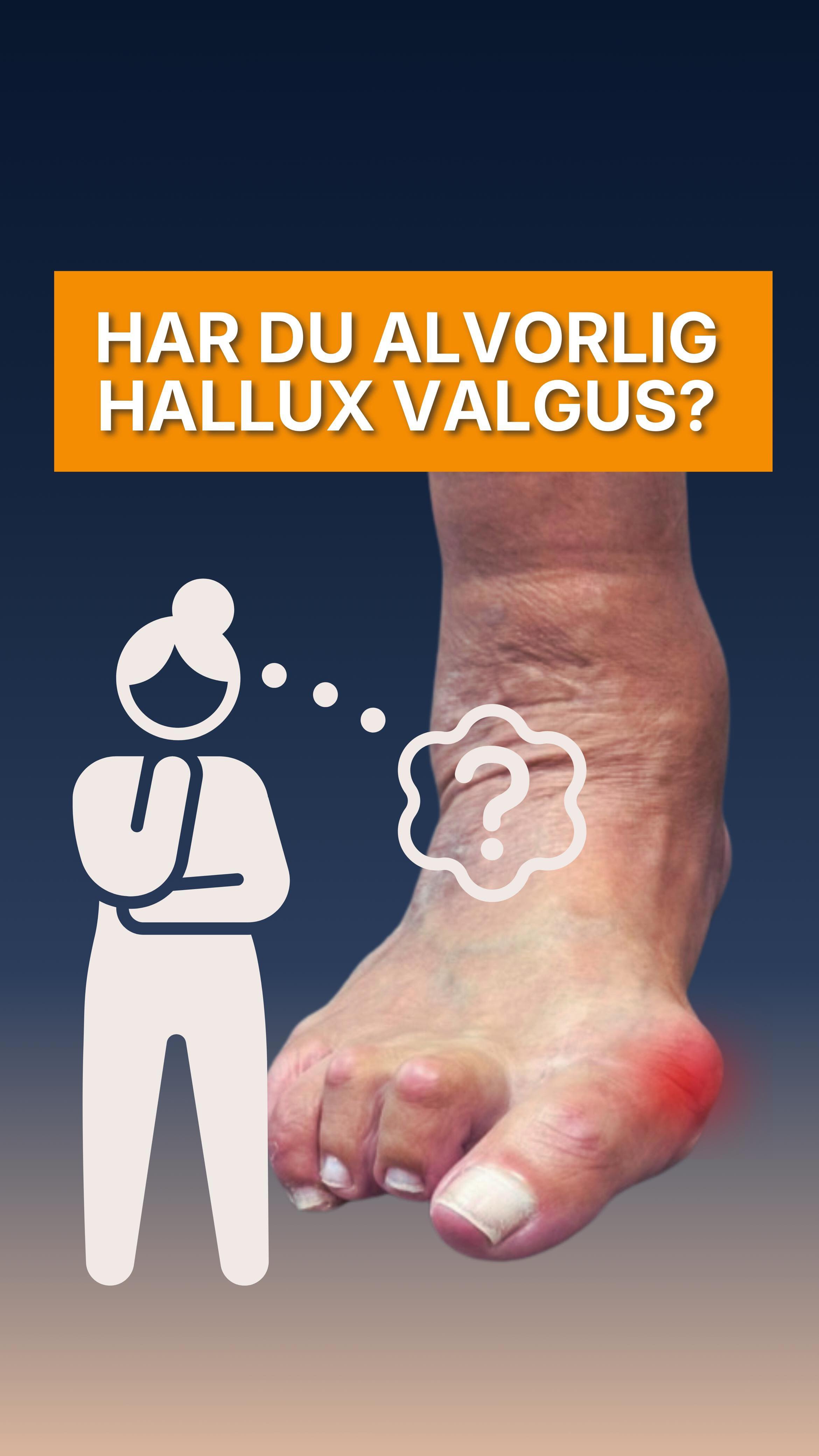 Har du en alvorlig hallux valgus, er tiden inne for å handle. Konservativbehandling kan kun hjelpe deg så mye. ⚠️🦶