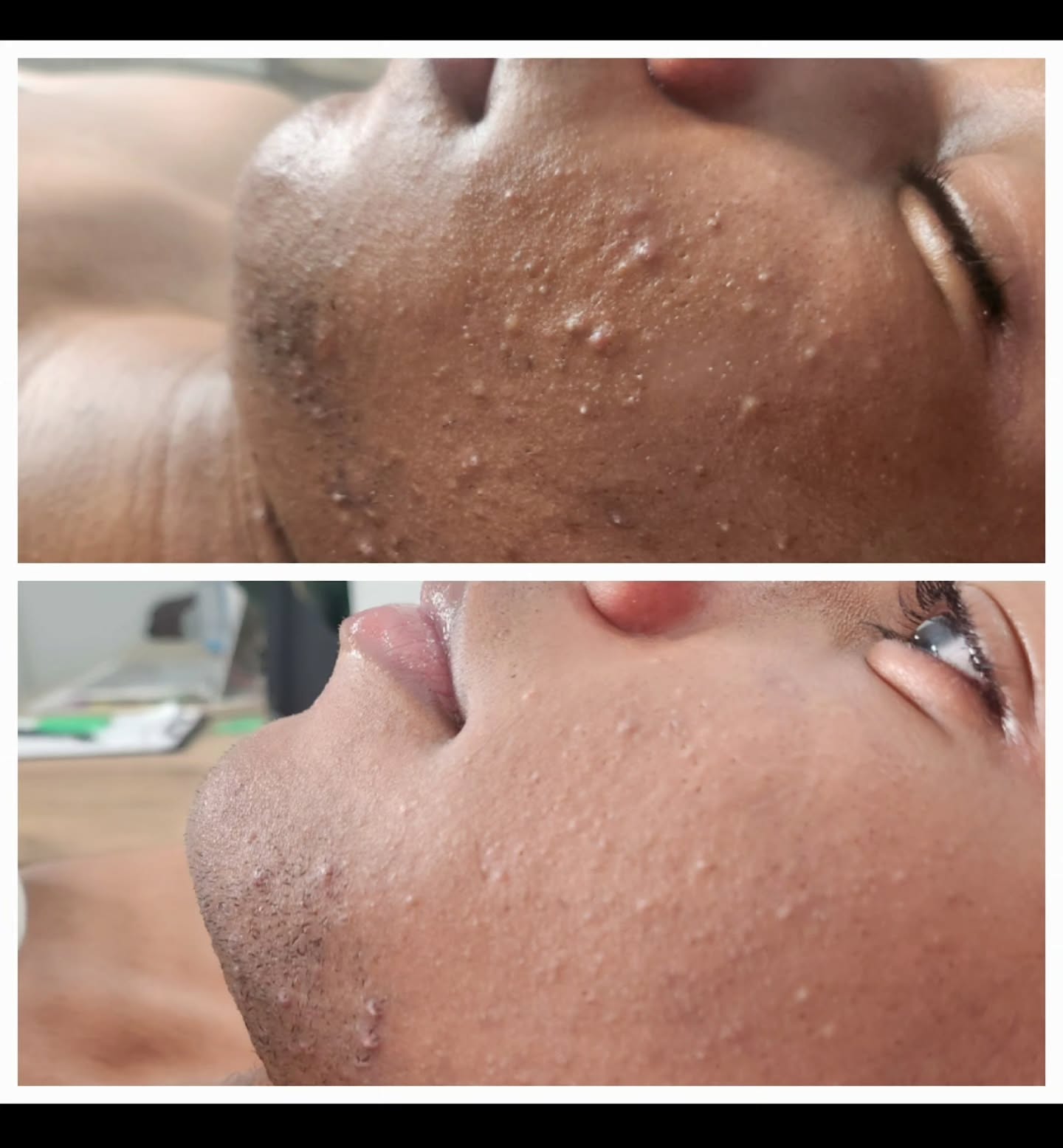 BEFORE & AFTER 2 MONTH of HOLISTIC CARE
#transformative
#professionalskincare
#professionalproducts
#LAWRENCEVILLEGEORGIA
Corrective facials are more than a treatment — they are a reset for acneic and problematic skin.
At The Modern Hue, we view each session as a clinical yet nurturing intervention: dissolving congestion, calming inflammation, restoring barrier health, and re-educating the skin to function optimally. With intentional exfoliation, advanced extractions, targeted actives, and healing modalities, we create visible change without compromising skin integrity. This is where correction meets care — and where problematic skin begins its transformation into balanced, resilient radiance.
WWW.THEMODERNHUE.COM 🎖
TEXT 518.894.7994 FOR DETAILS