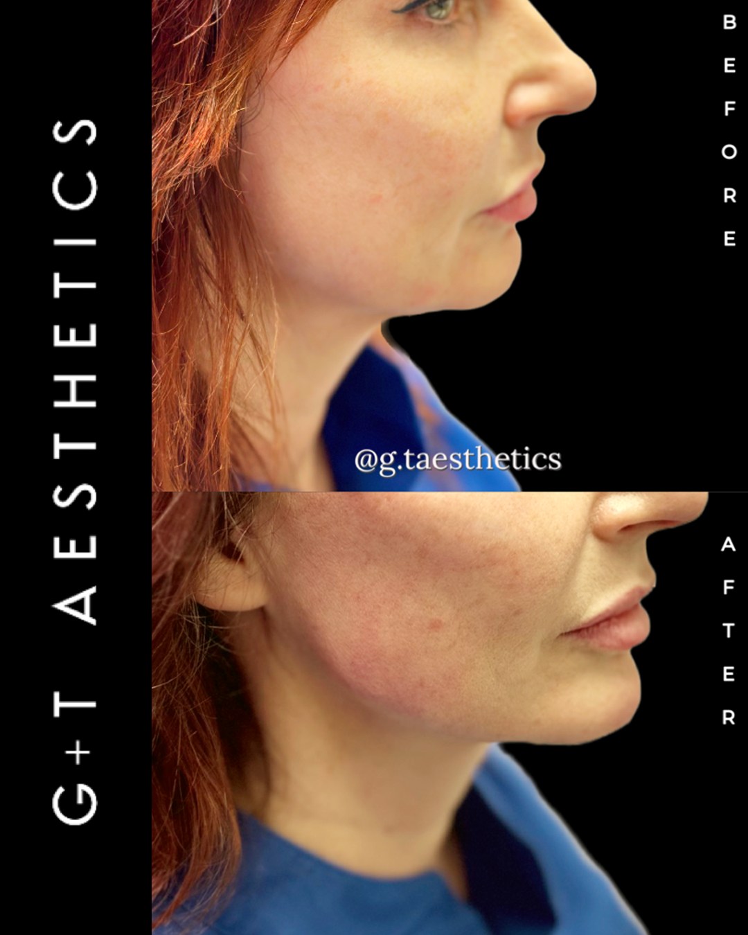 Defined jawline. Balanced profile. ✨
Chin and jawline fillers enhance facial contours, giving structure and a subtle lift.
📲Enquire or visit www.gtaesthetics.co.uk for more info.
#ChinFillers #JawlineContouring #DermalFillers #FacialRejuvenation #BeforeAndAfter #StamfordAesthetics