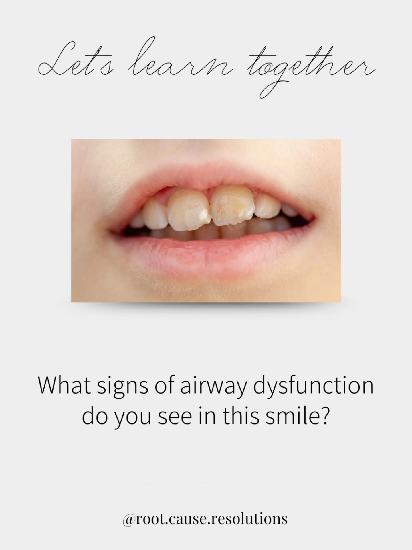 Smiles tell stories.
The question is whether we’ve trained ourselves to read them.
➡️ Open mouth posture
➡️ Dry, chapped lips
➡️ Low lip tone at rest
These are not cosmetic observations.
They’re functional findings.
This is why airway-aware providers don’t stop at “clean teeth.”
We assess
✅️ Lip seal at rest
✅️ Tongue posture
✅️ Nasal patency
✅️ Palatal form
✅️ Periodontal inflammatory patterns
✅️ Sleep and fatigue history
What do you see?
#dentistry #airwaymanagement #tonguetie #sleep #rdh