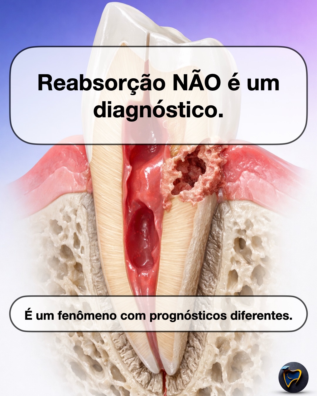 Sugestão de legenda para o carrossel:
Reabsorção dentária não é “uma coisa só”.
É um fenômeno biológico com origens diferentes, condutas diferentes e prognósticos completamente distintos.
O maior erro clínico é simples — e comum: tratar a imagem radiográfica sem classificar o tipo de reabsorção.
✅ No HUB/Guia completo eu organizei, de forma prática:
como diferenciar interna vs externa (e onde o diagnóstico costuma falhar)
quando a TCFC/CBCT realmente muda a decisão (sem banalizar exame)
um mapa de conduta para: interna, externa inflamatória, substituição/anquilose, e ECR
checklist de consulta + atalhos para os protocolos satélites
📌 Salve este post (vai virar referência no consultório).
💬 Comente “GUIA” que eu te mando nos stories o caminho mais rápido para acessar.
🔗 Acesse o HUB:
https://www.endotoday.com.br/post/reabsorções-dentárias-na-endodontia-guia
#endodontia #odontologia #tratamentodecanal #dentista #reabsorçãoradicular