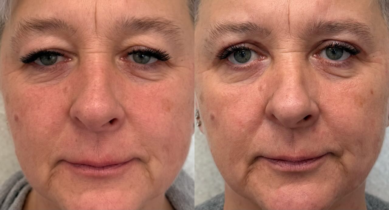 Efekt po miesiącu od wykonania zabiegu blefaroplastyki powiek górnych.👁️👨⚕️
Finalny efekt po upływie około pół roku od wykonanego zabiegu.
Zapraszamy 🤍
📞693-101-233